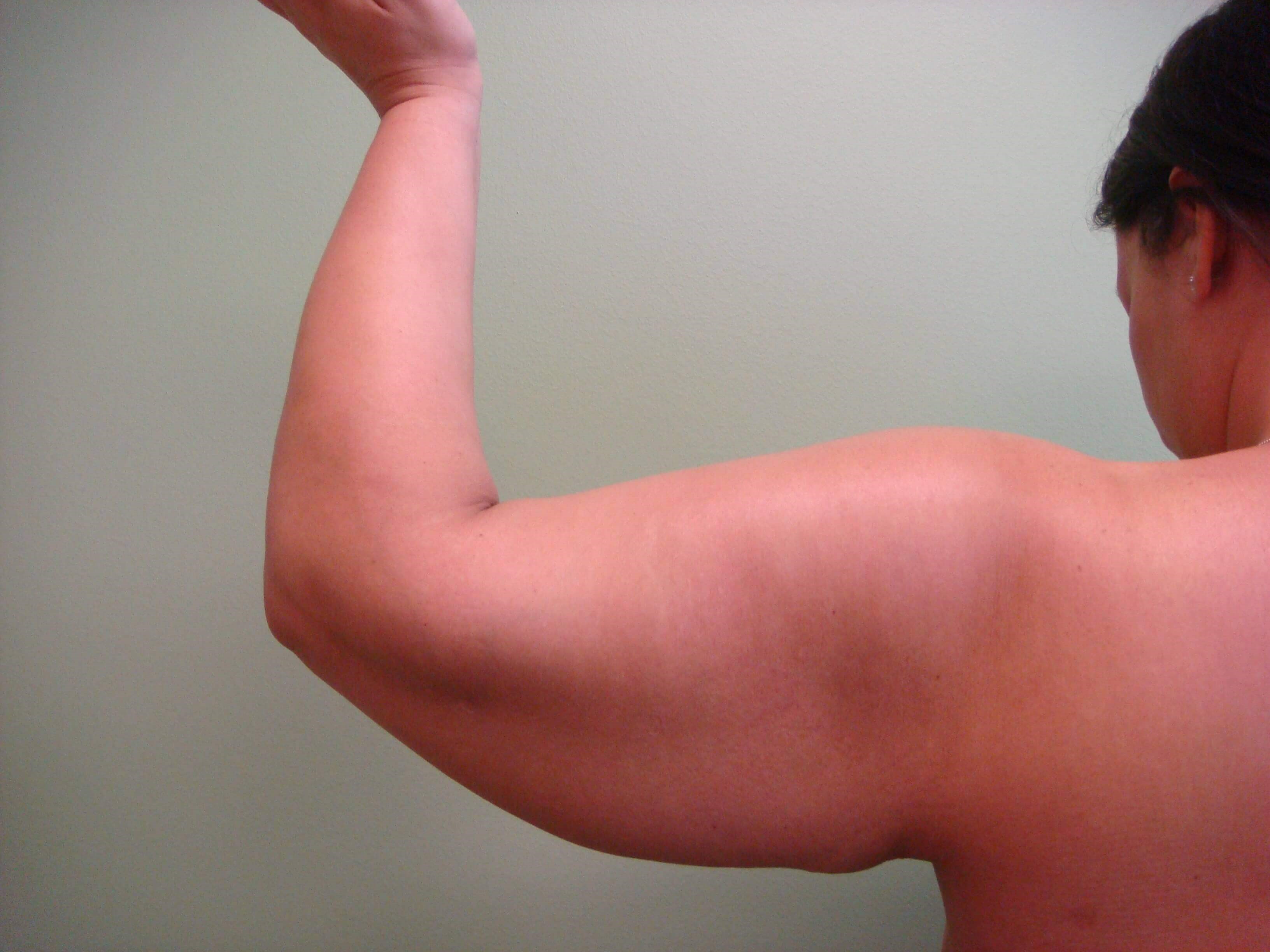 Brachioplasty (Arm Lift) Before