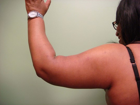 Brachioplasty (Arm Lift) After