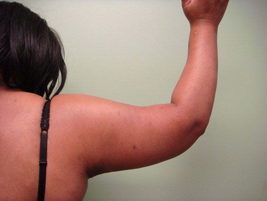 Brachioplasty (Arm Lift) After
