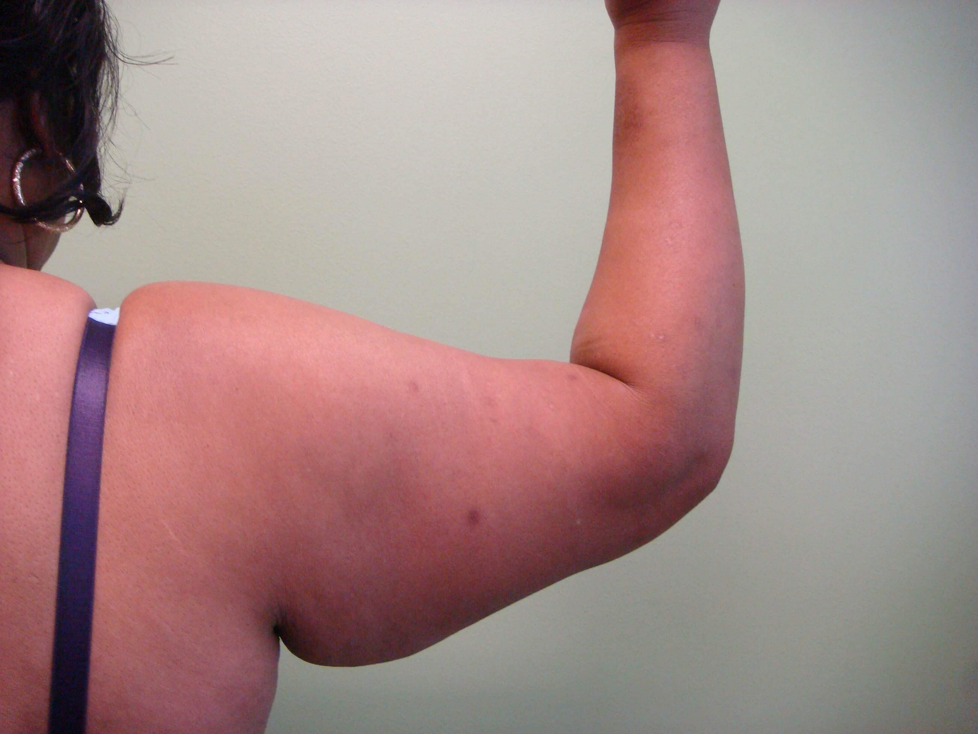 Brachioplasty (Arm Lift) Before