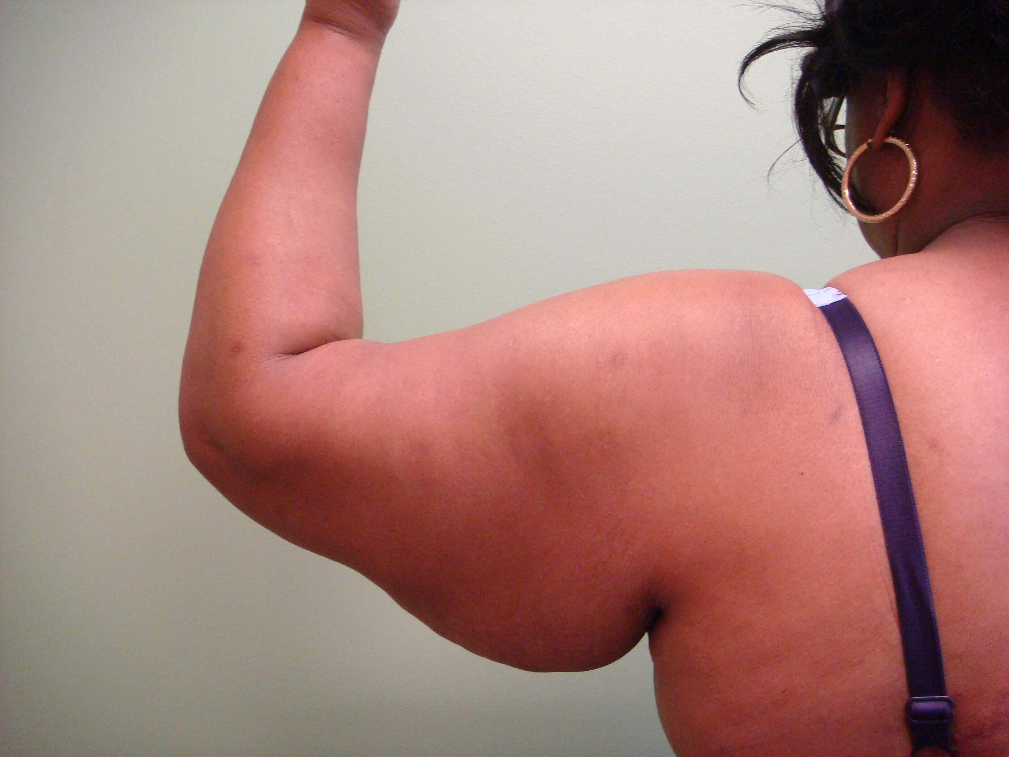 Brachioplasty (Arm Lift) Before
