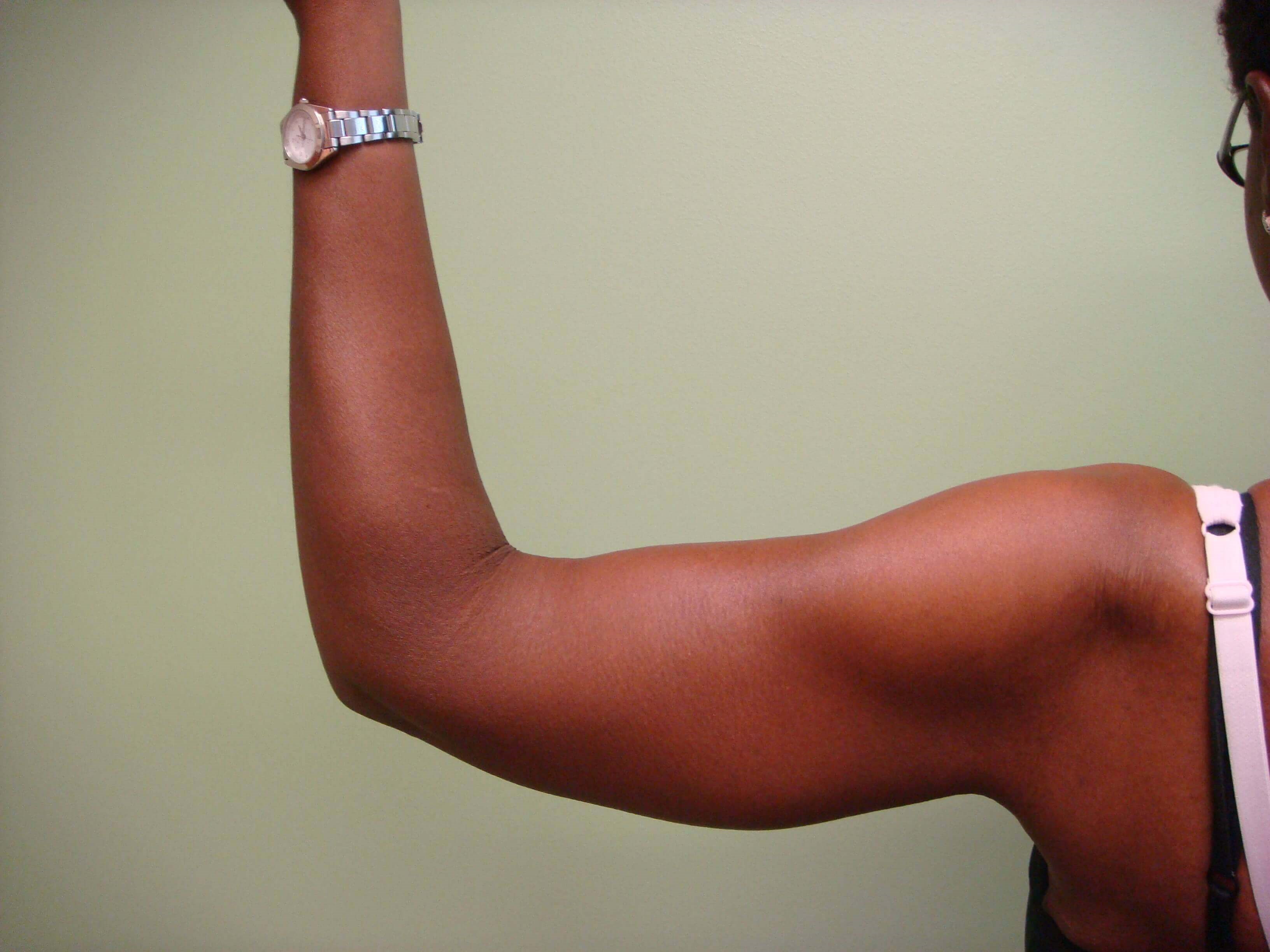 Brachioplasty (Arm Lift) After