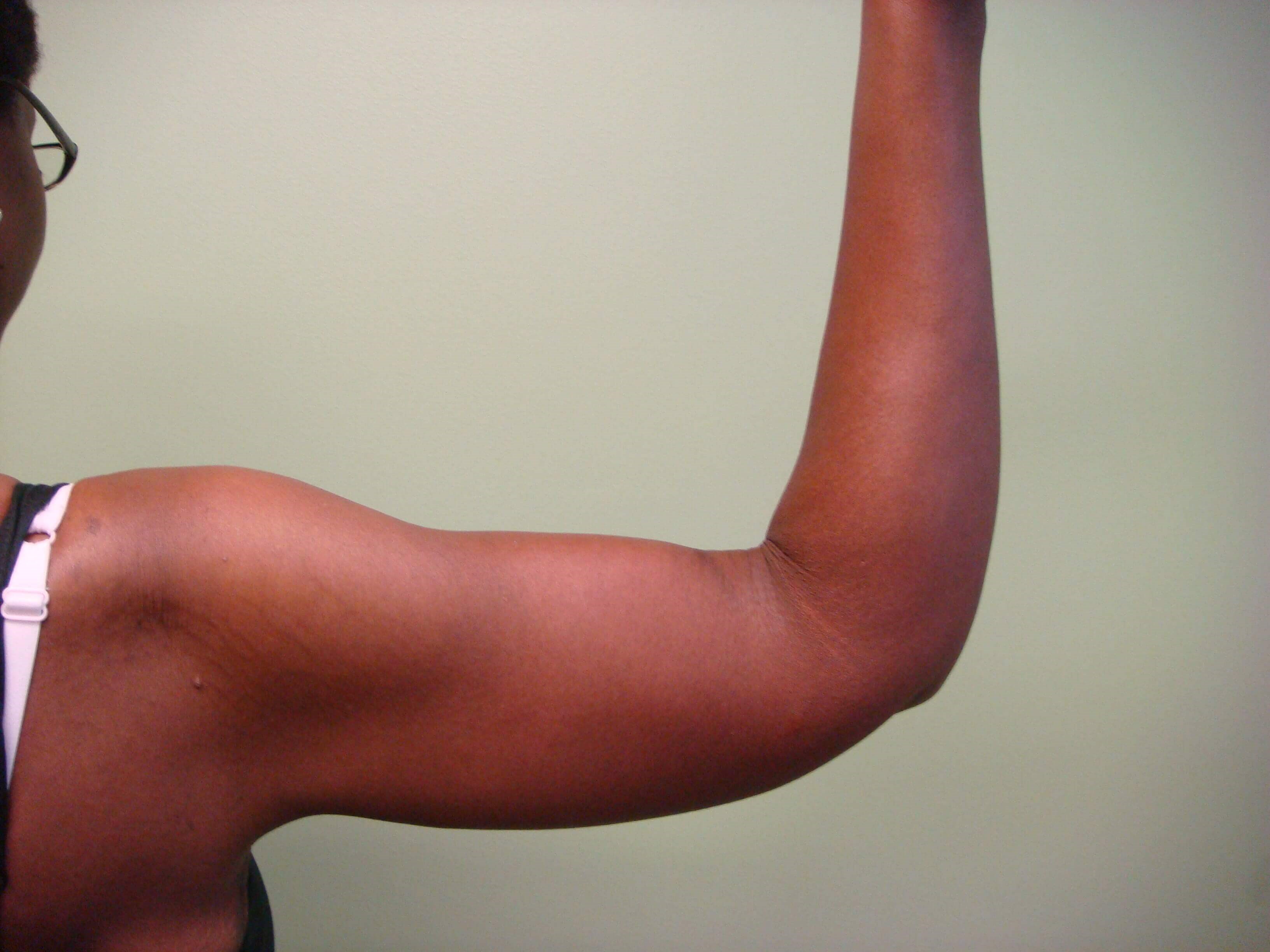 Brachioplasty (Arm Lift) After