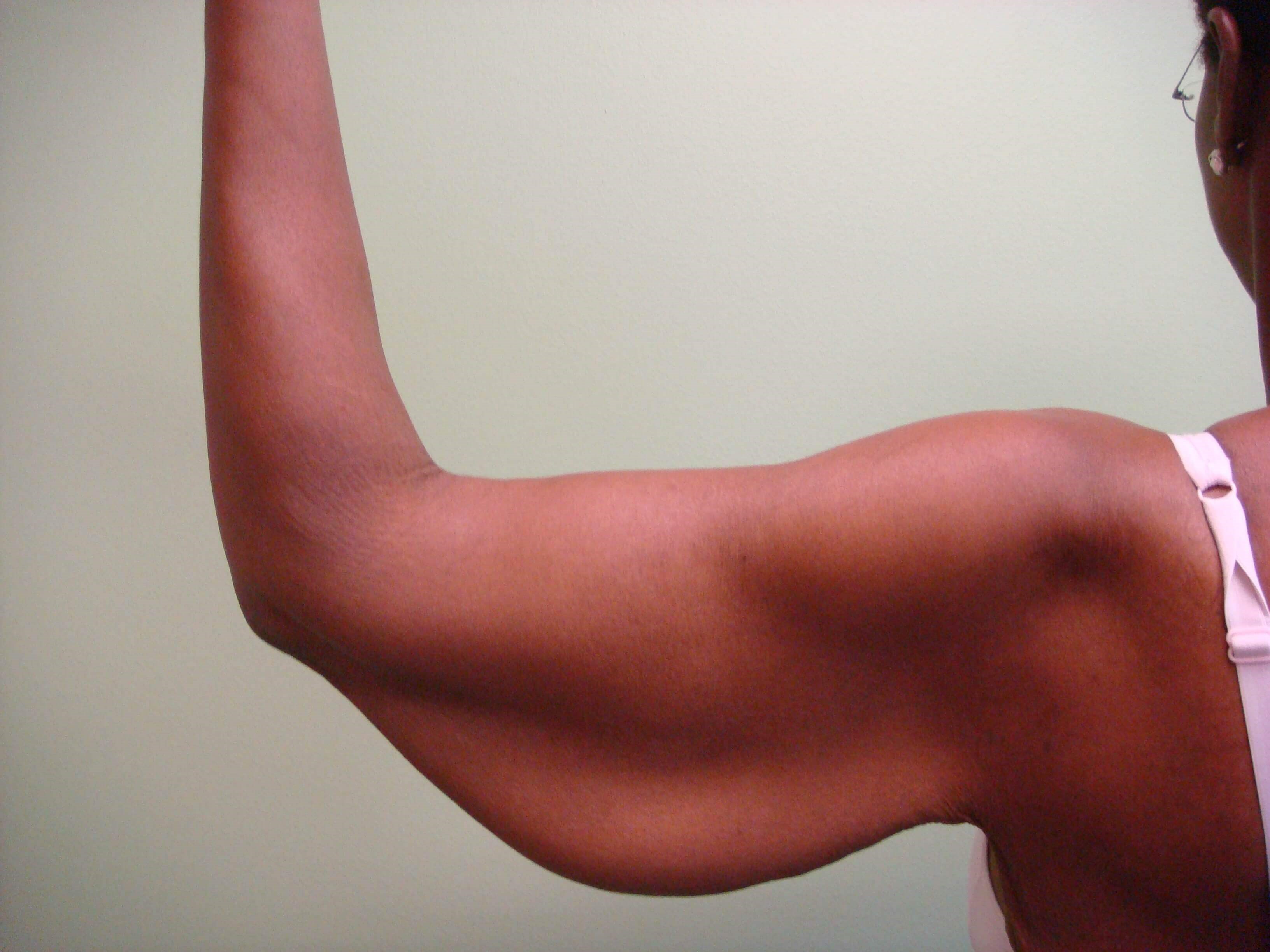 Brachioplasty (Arm Lift) Before