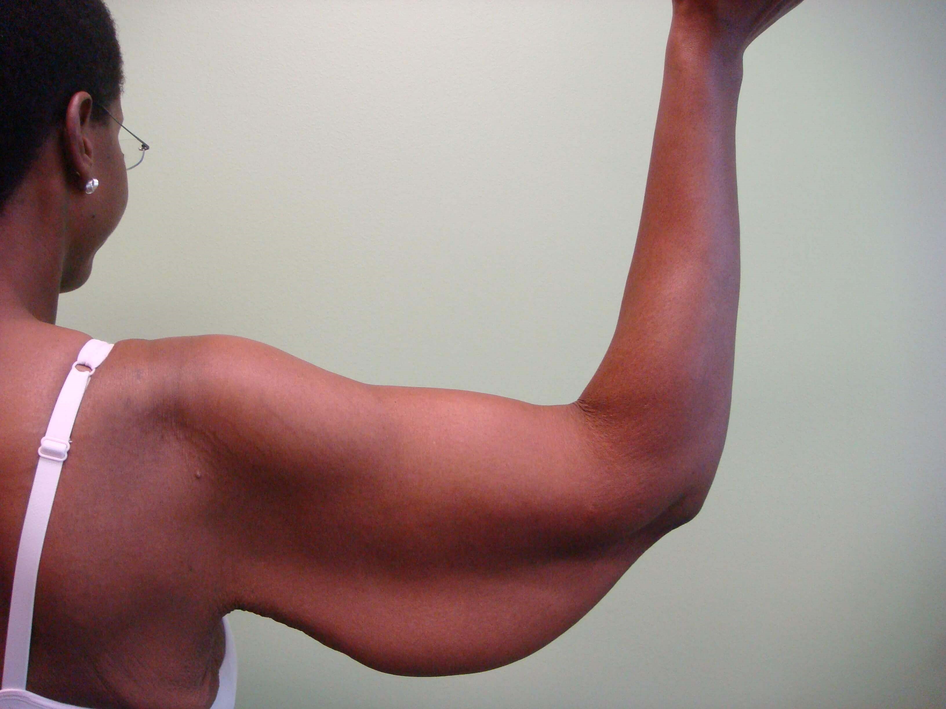 Brachioplasty (Arm Lift) Before