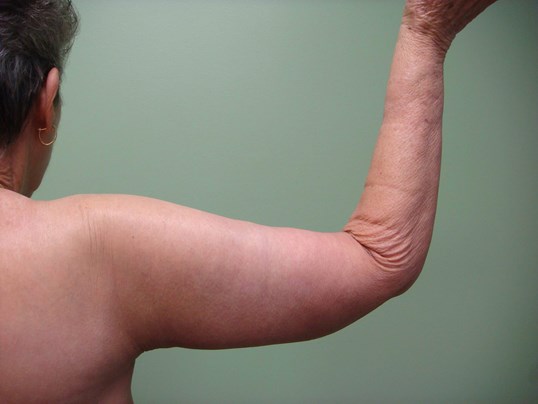 Brachioplasty (Arm Lift) After