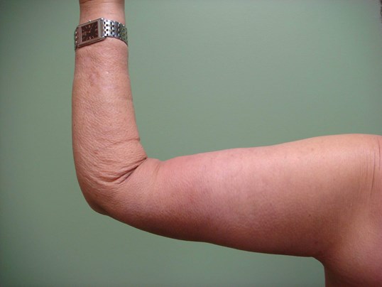 Brachioplasty (Arm Lift) After