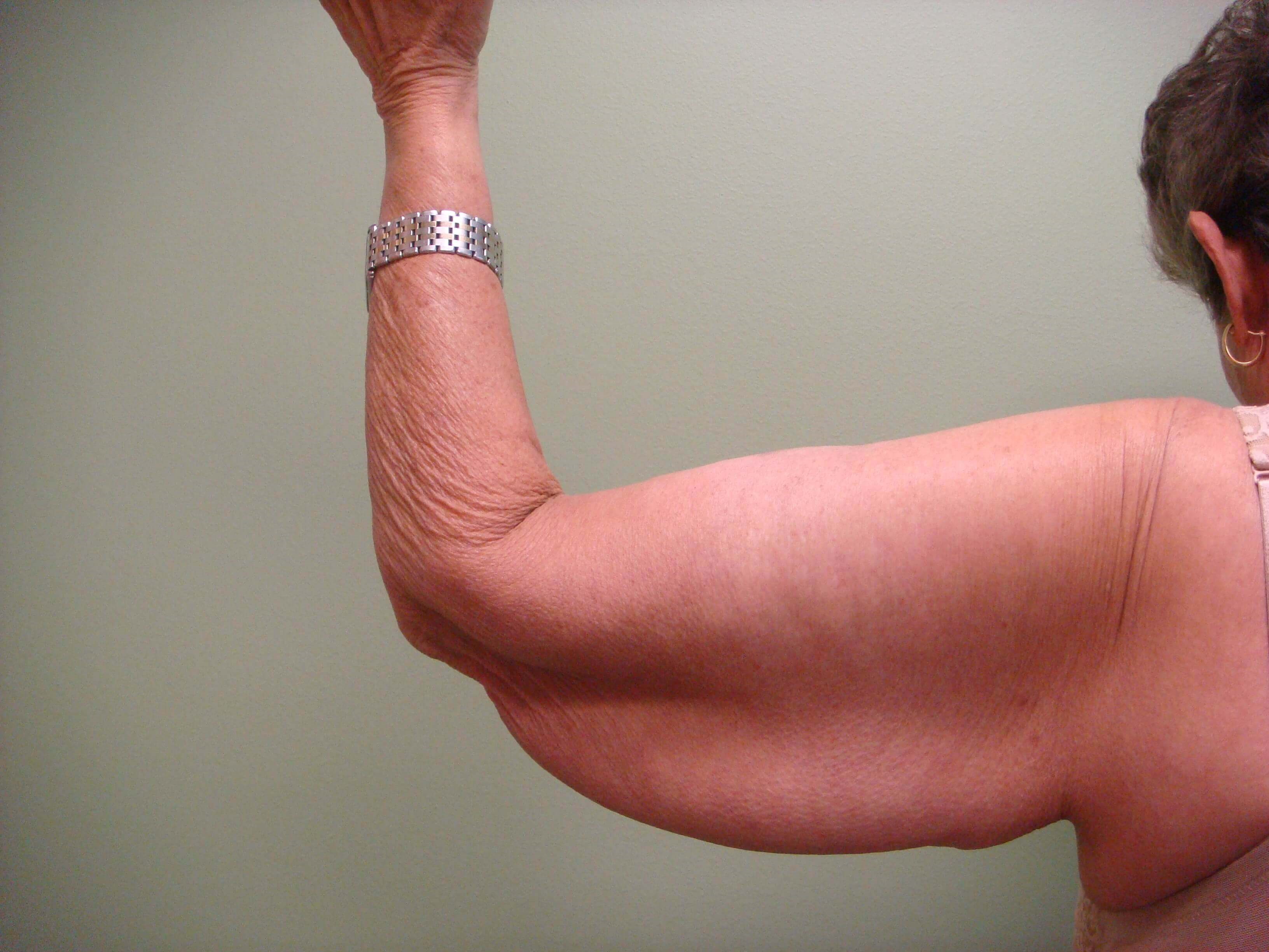 Brachioplasty (Arm Lift) Before
