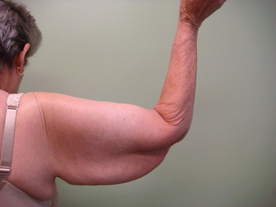 Brachioplasty (Arm Lift) Before