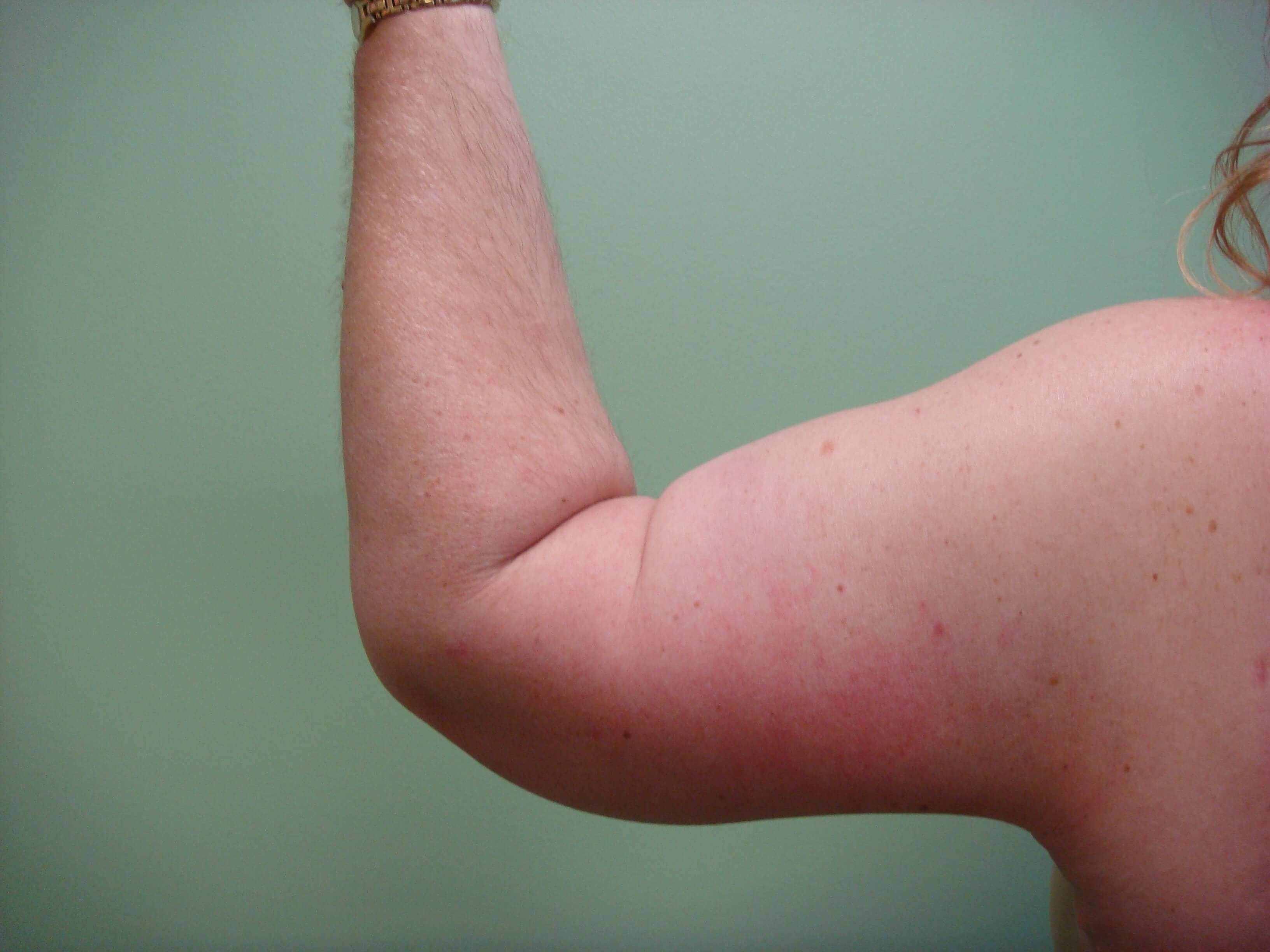 Brachioplasty (Arm Lift) After