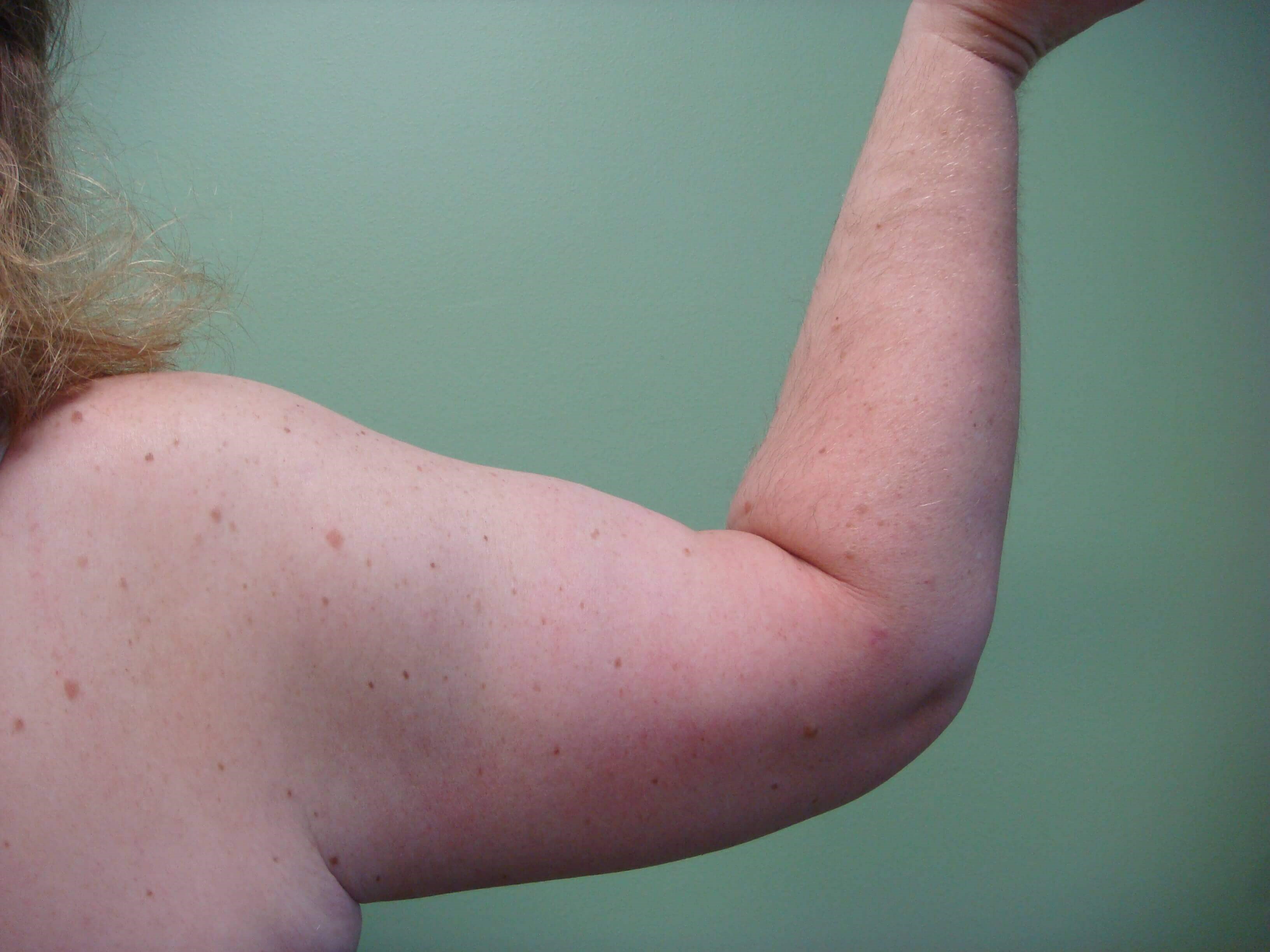 Brachioplasty (Arm Lift) After