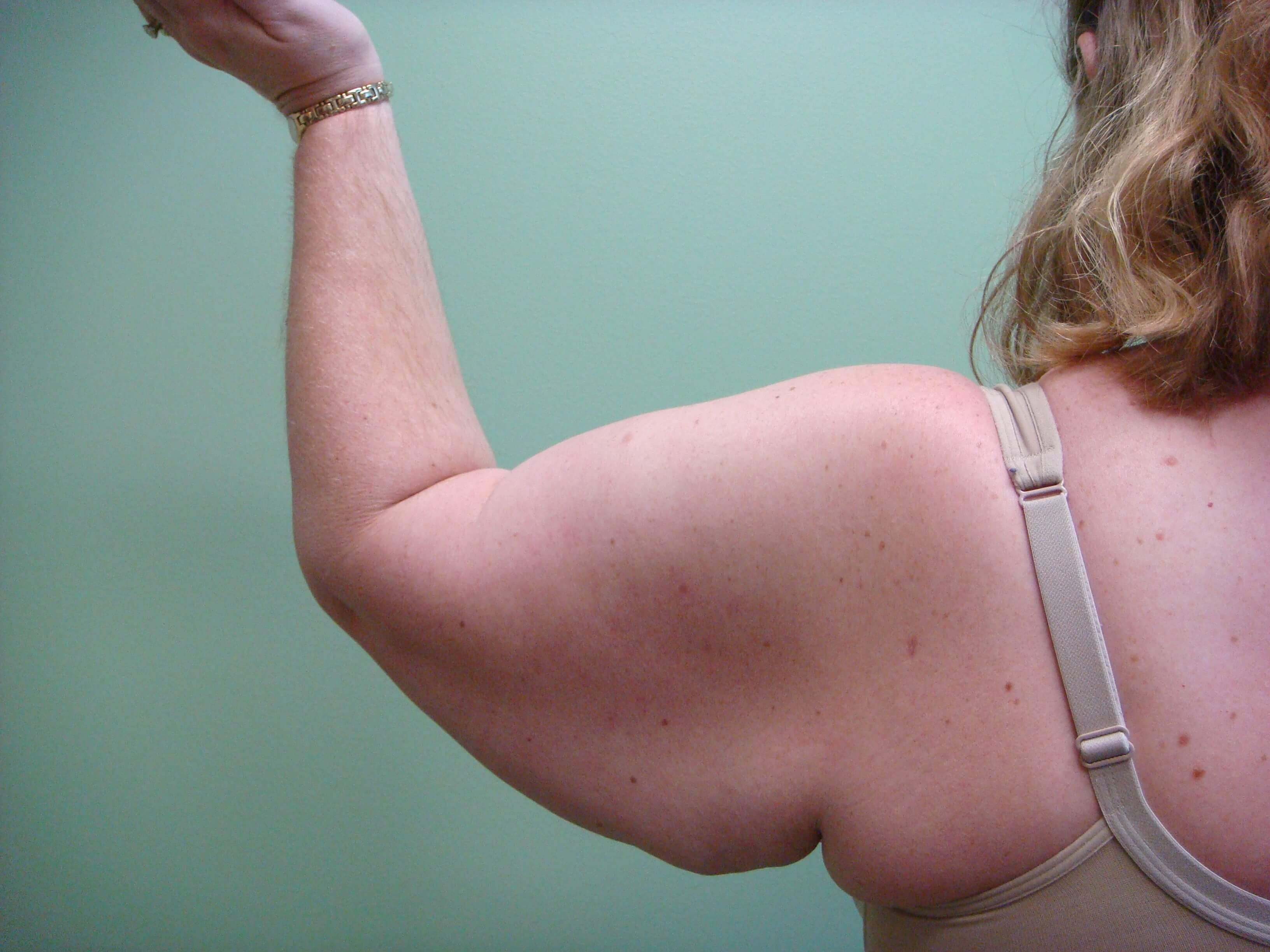 Brachioplasty (Arm Lift) Before