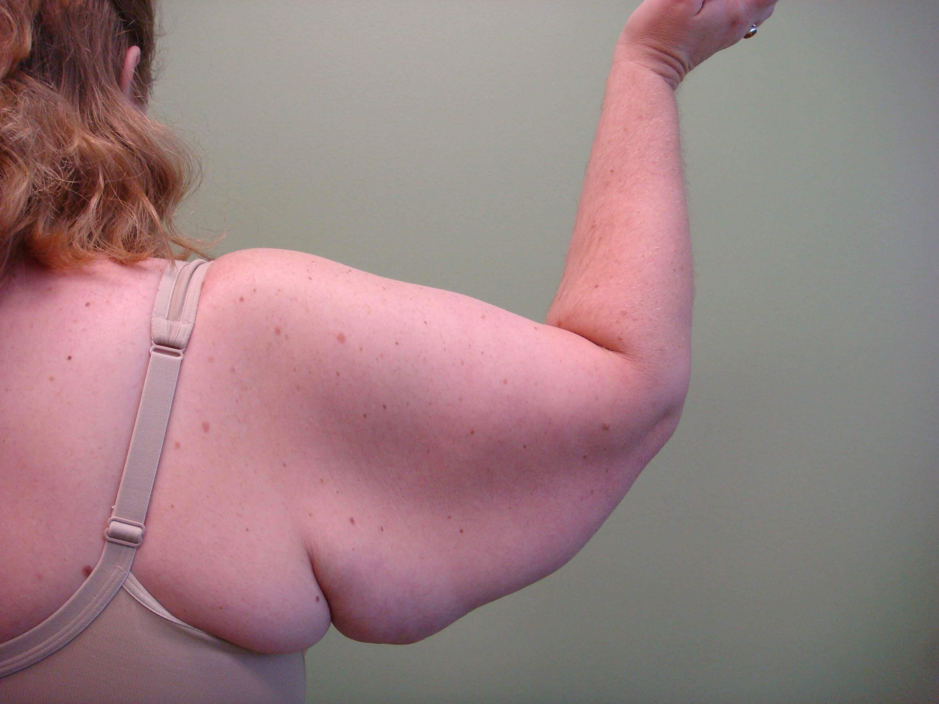 Brachioplasty (Arm Lift) Before