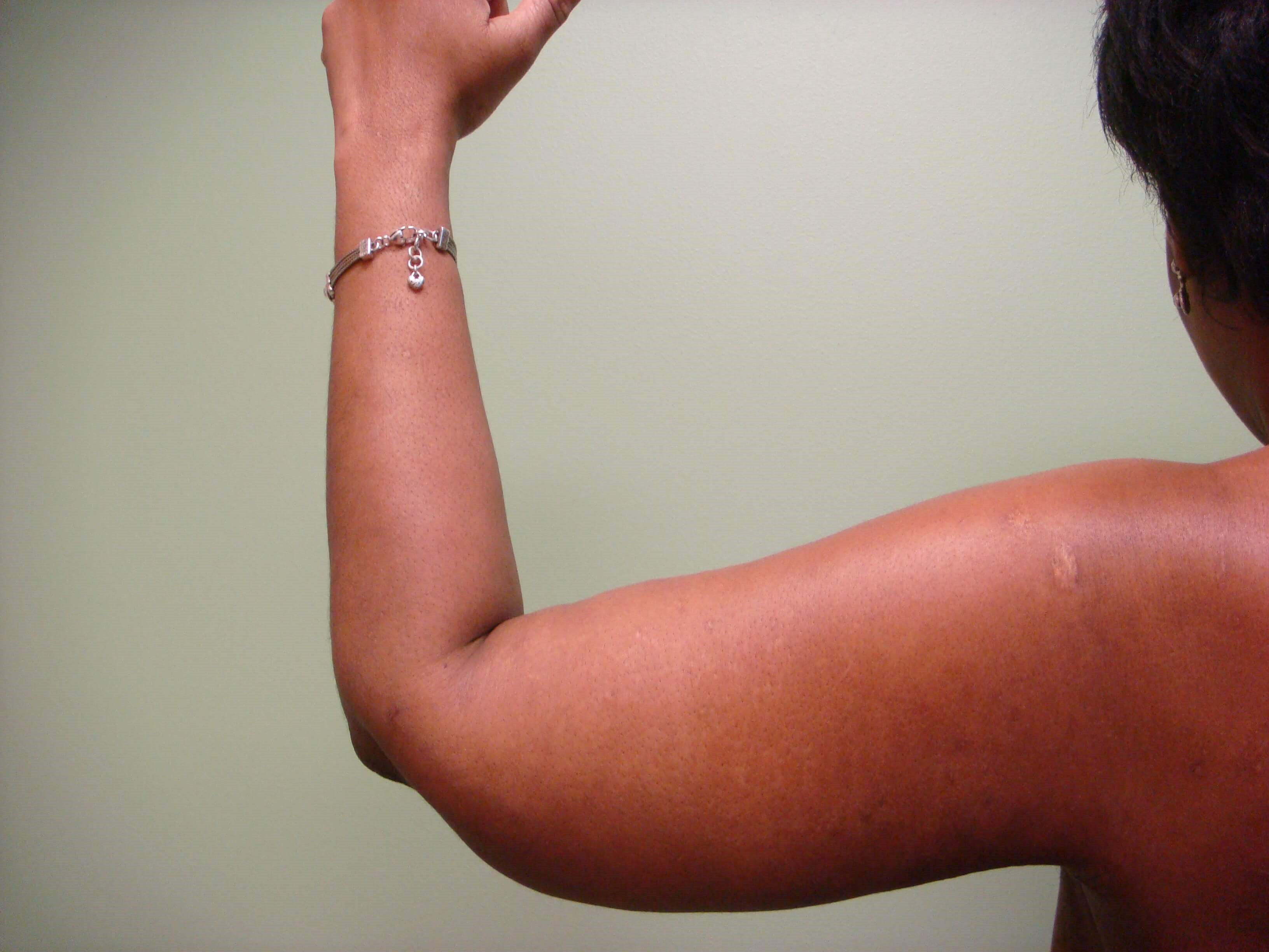 Brachioplasty (Arm Lift) After
