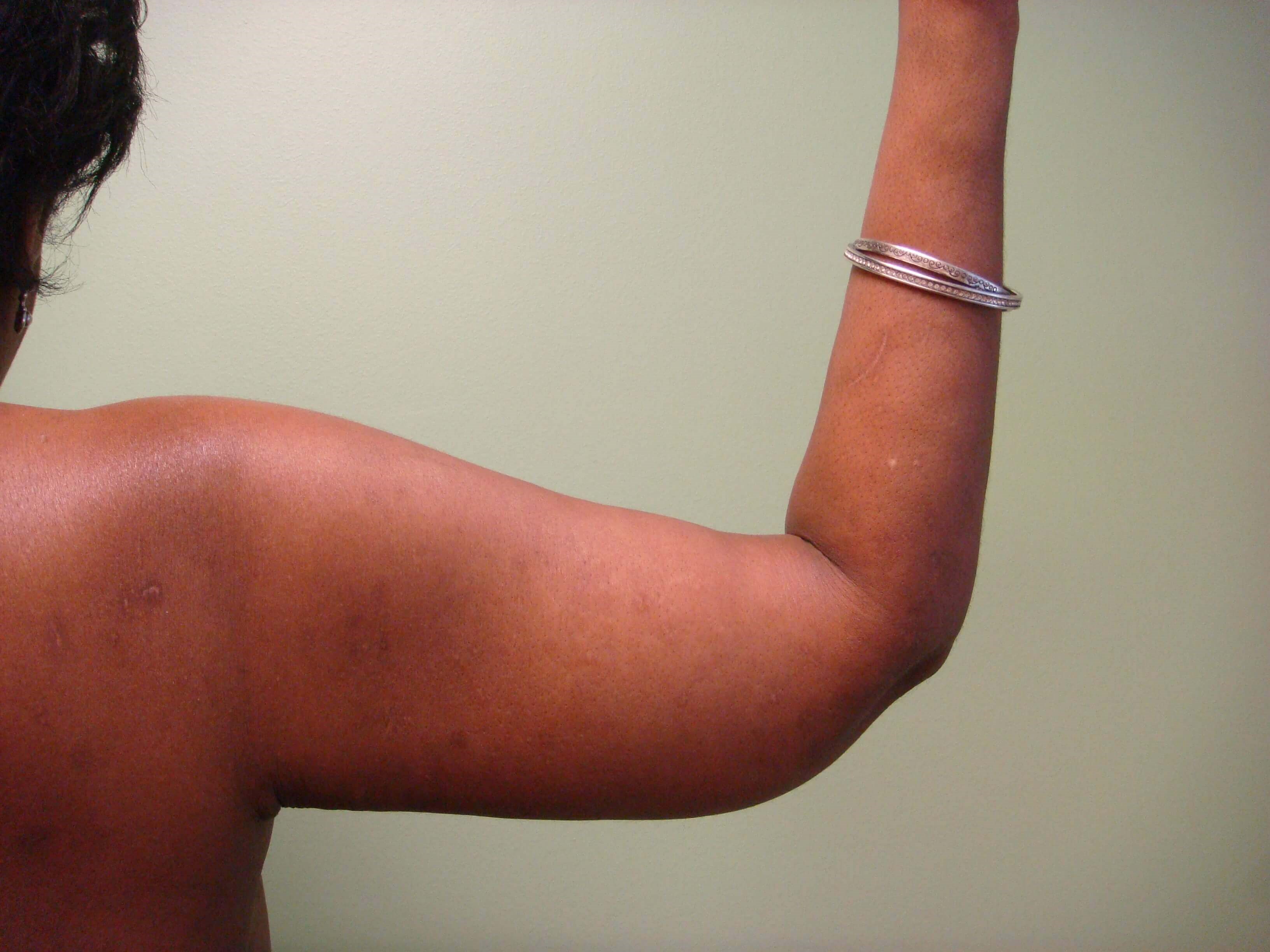 Brachioplasty (Arm Lift) After