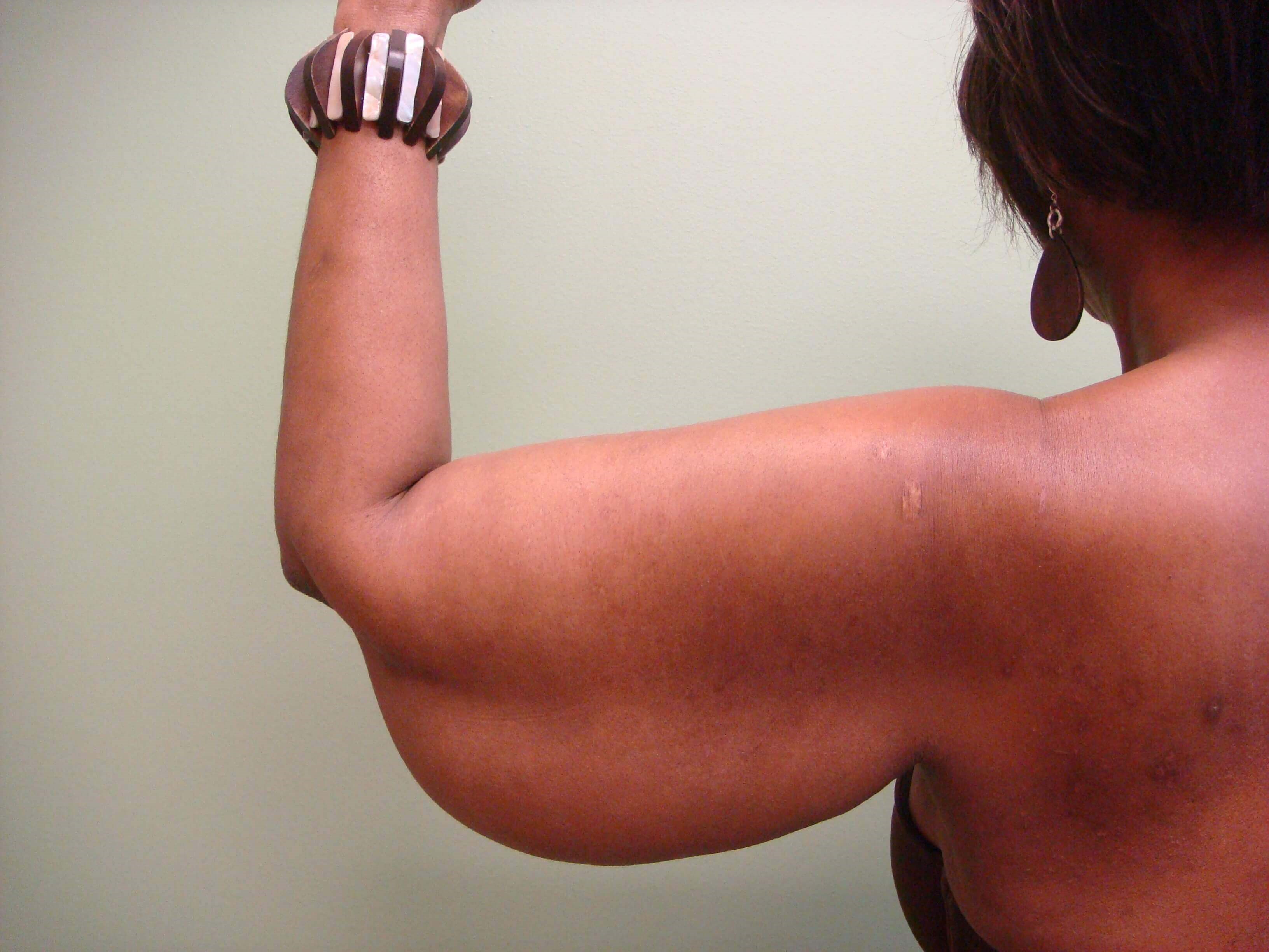 Brachioplasty (Arm Lift) Before