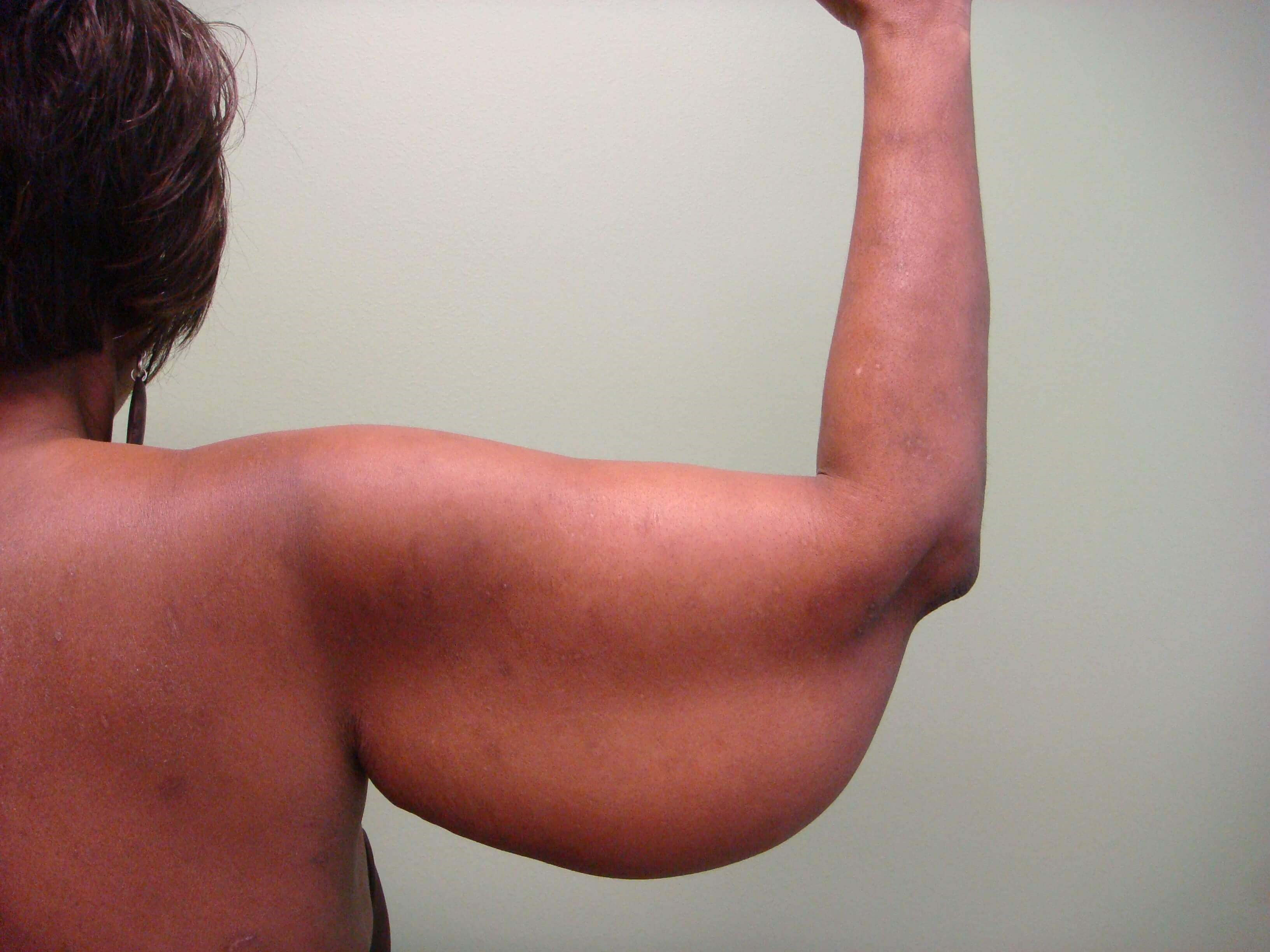 Brachioplasty (Arm Lift) Before