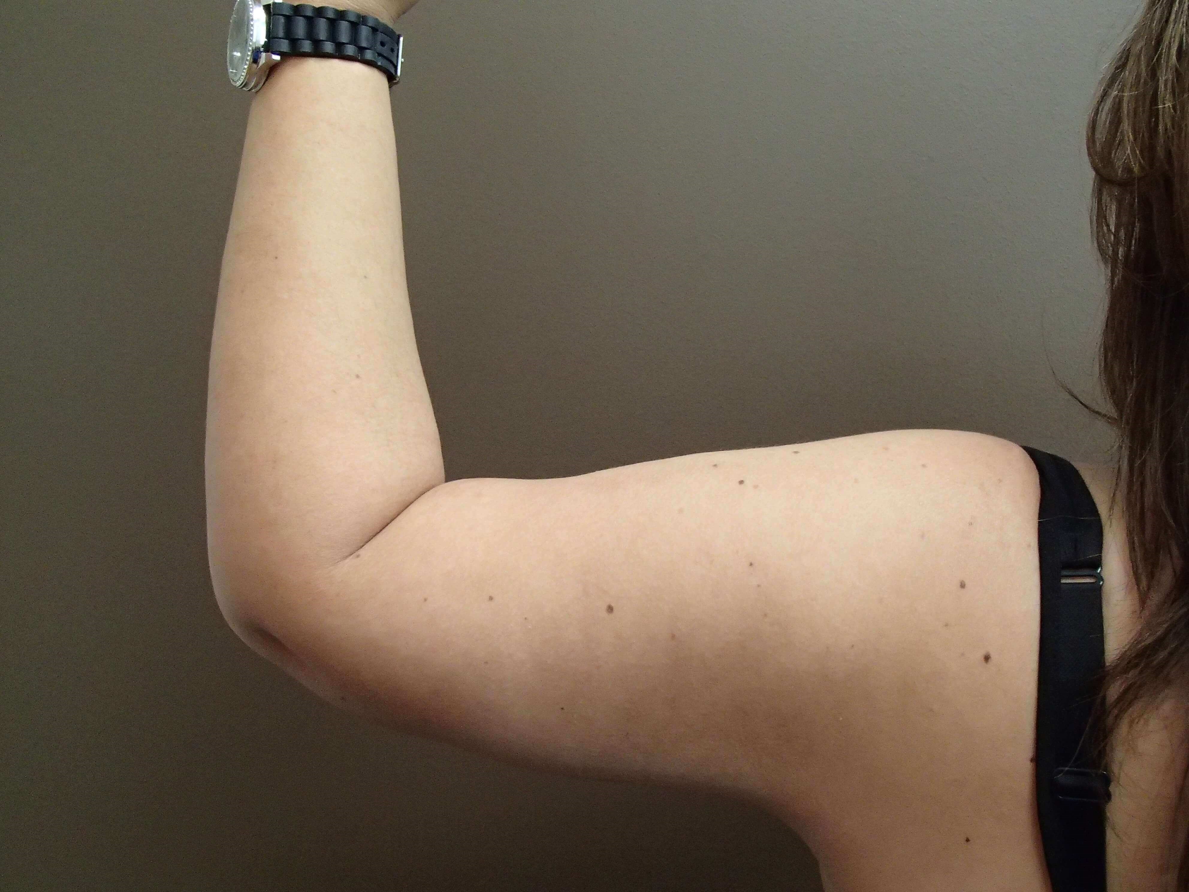 Brachioplasty (Arm Lift) After