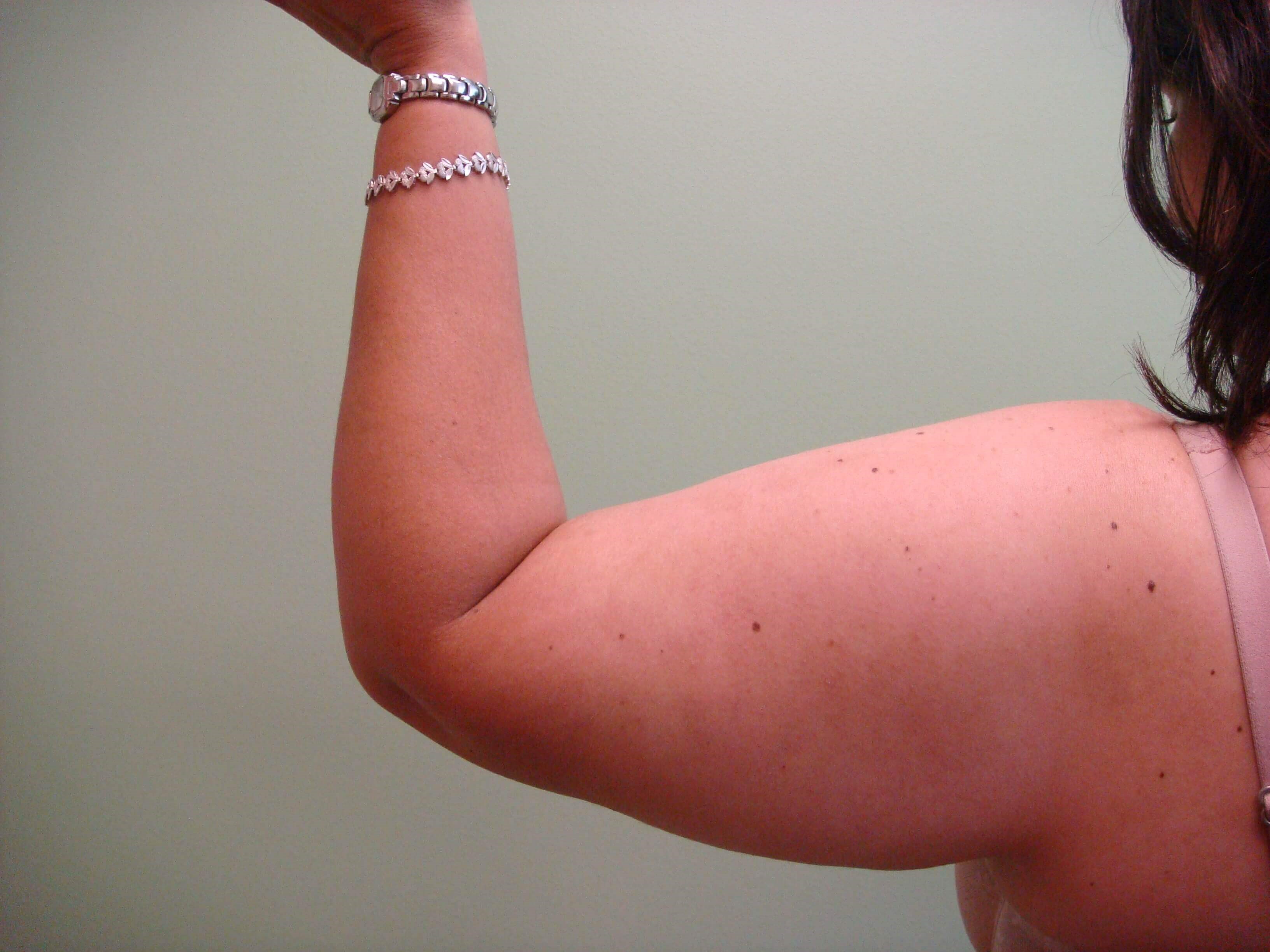 Brachioplasty (Arm Lift) Before