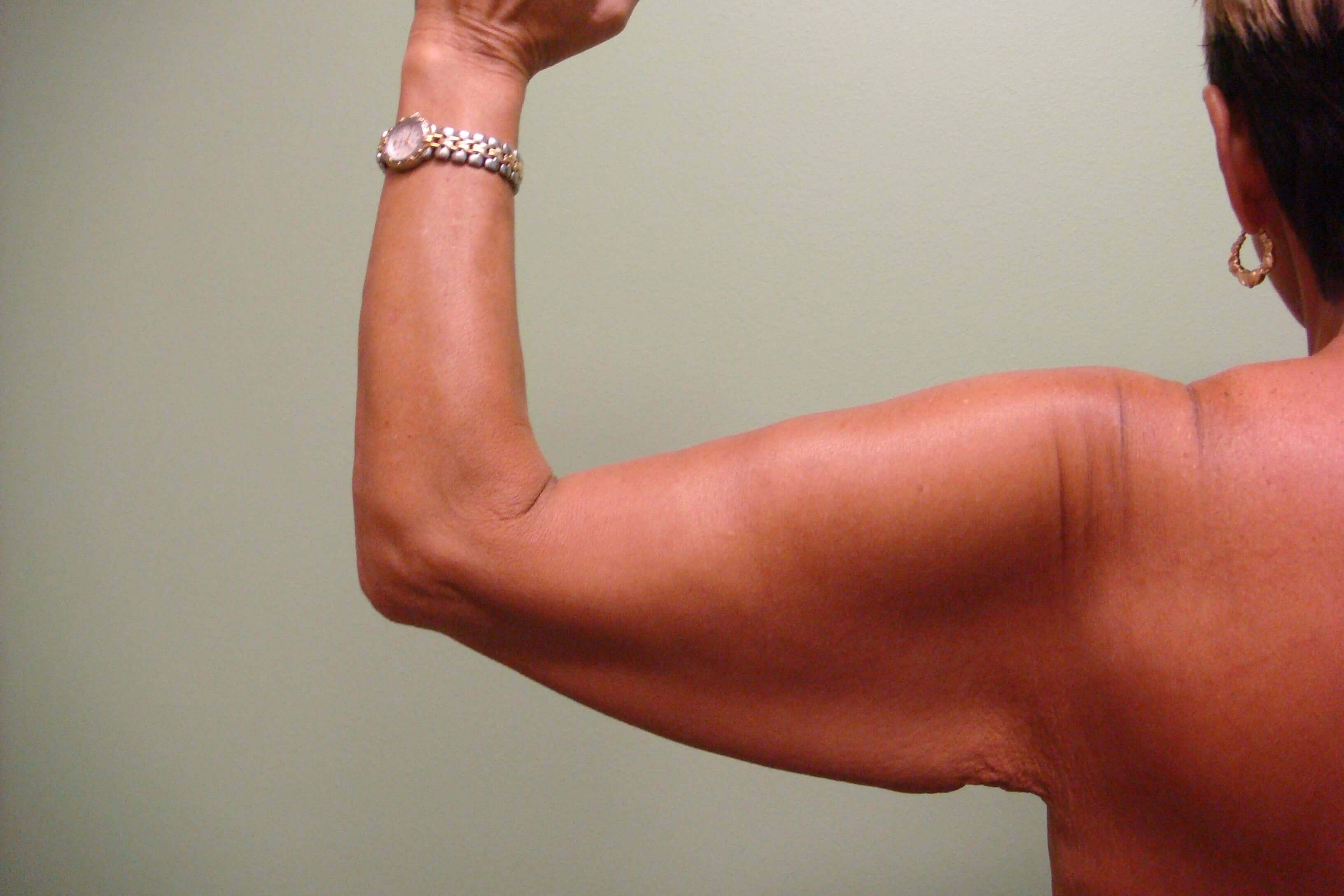 Brachioplasty (Arm Lift) Before