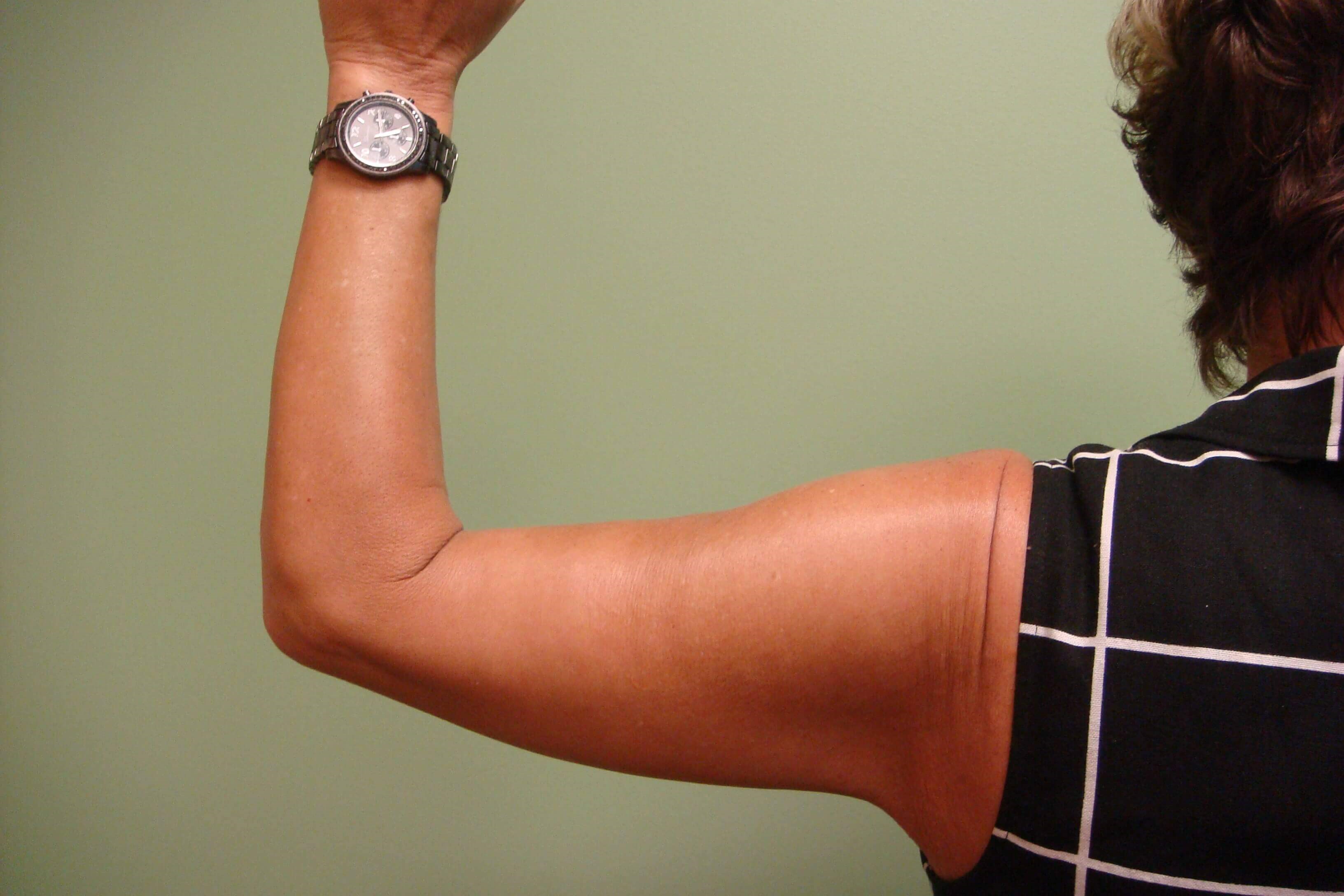 Brachioplasty (Arm Lift) After