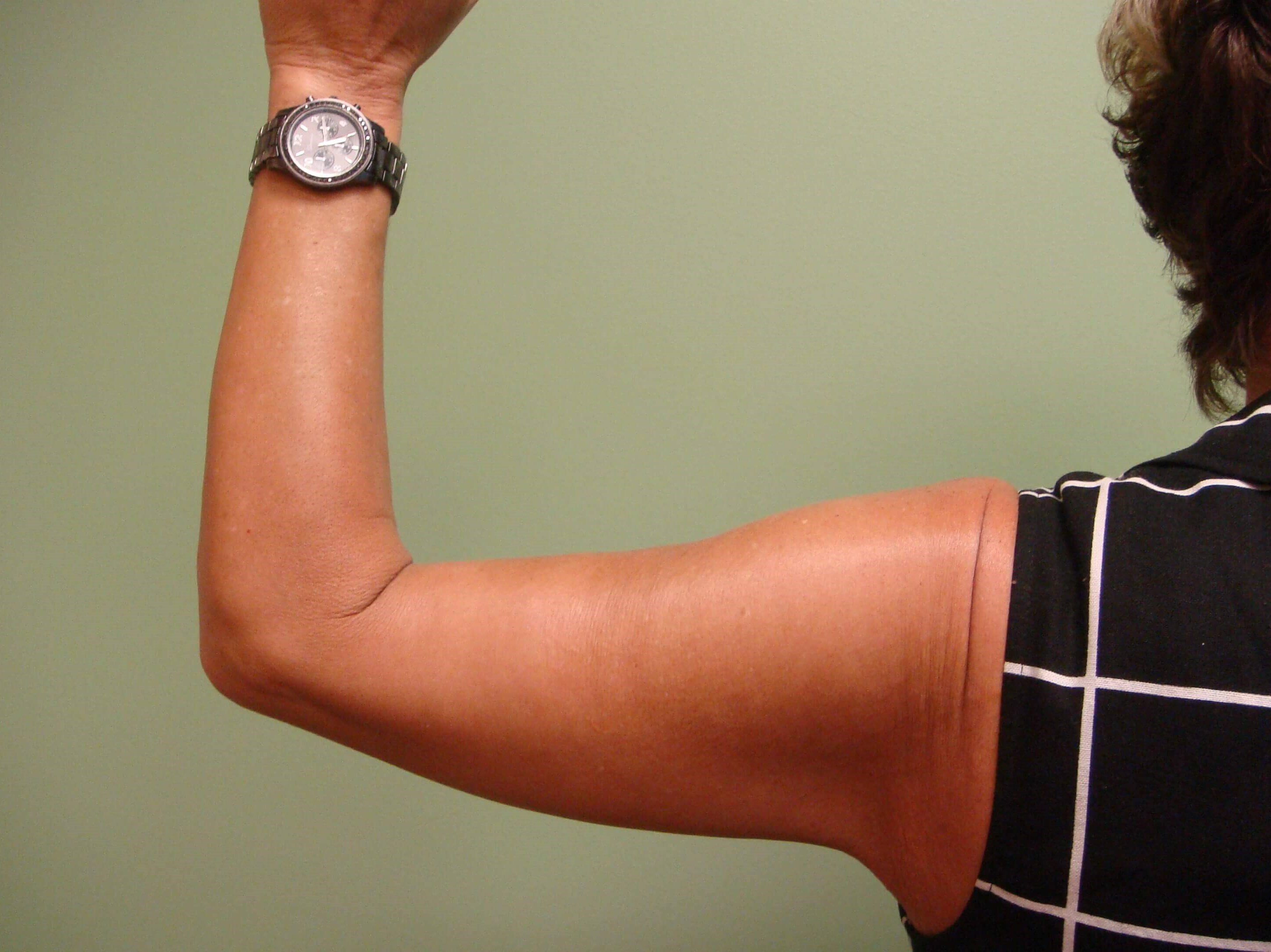 Brachioplasty (Arm Lift) After