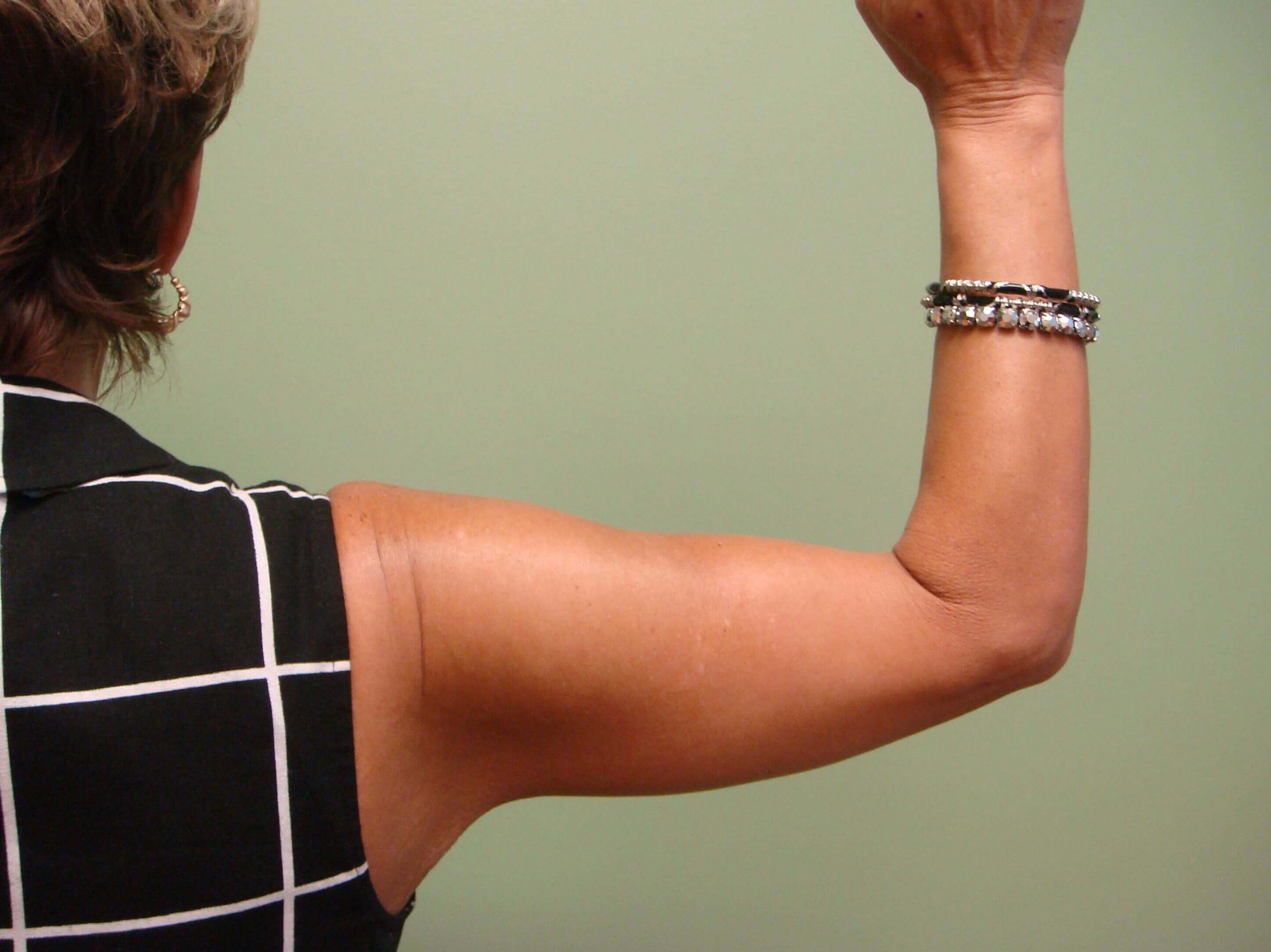 Brachioplasty (Arm Lift) After