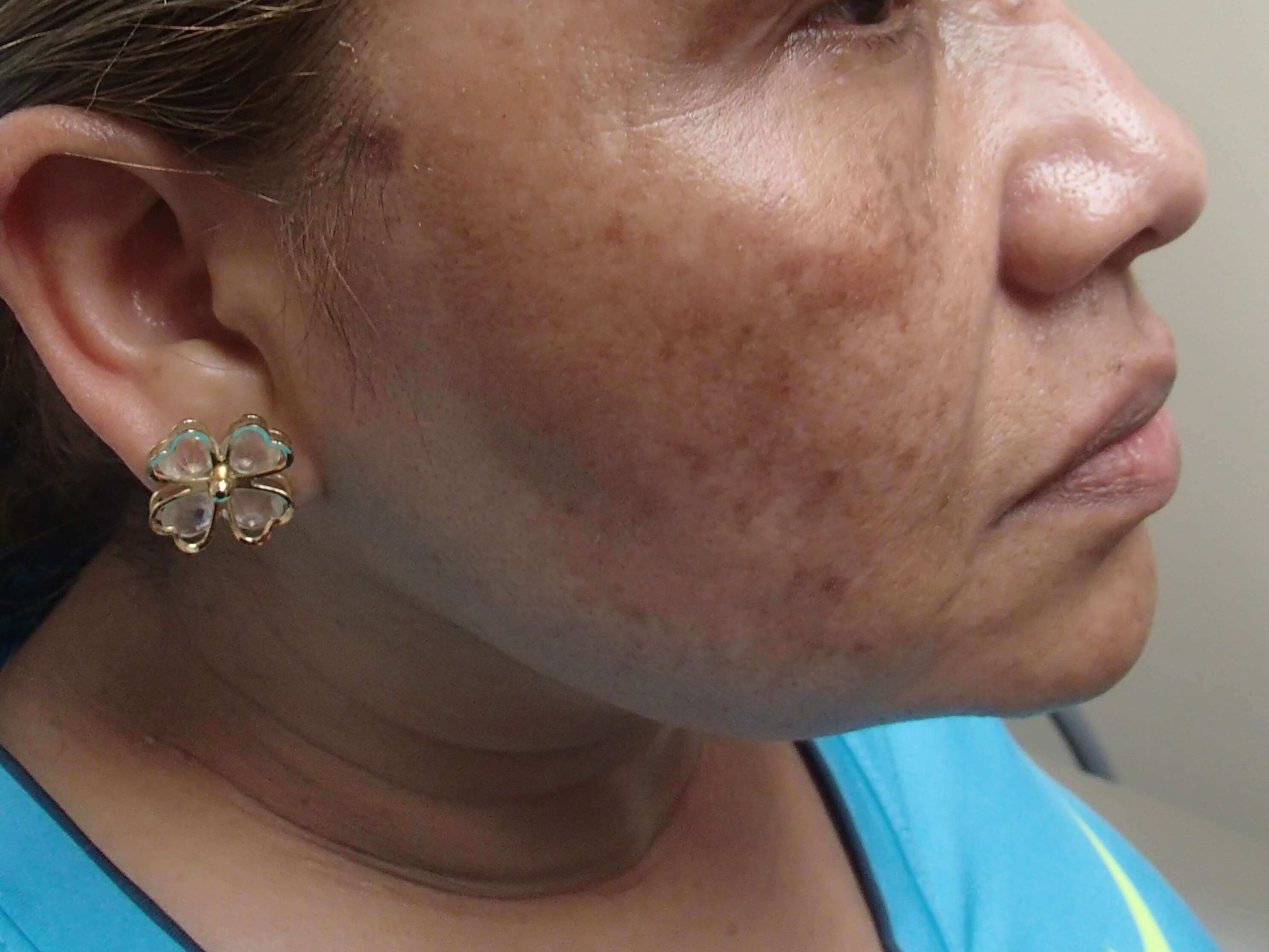 VI Precision Plus Peel Before
