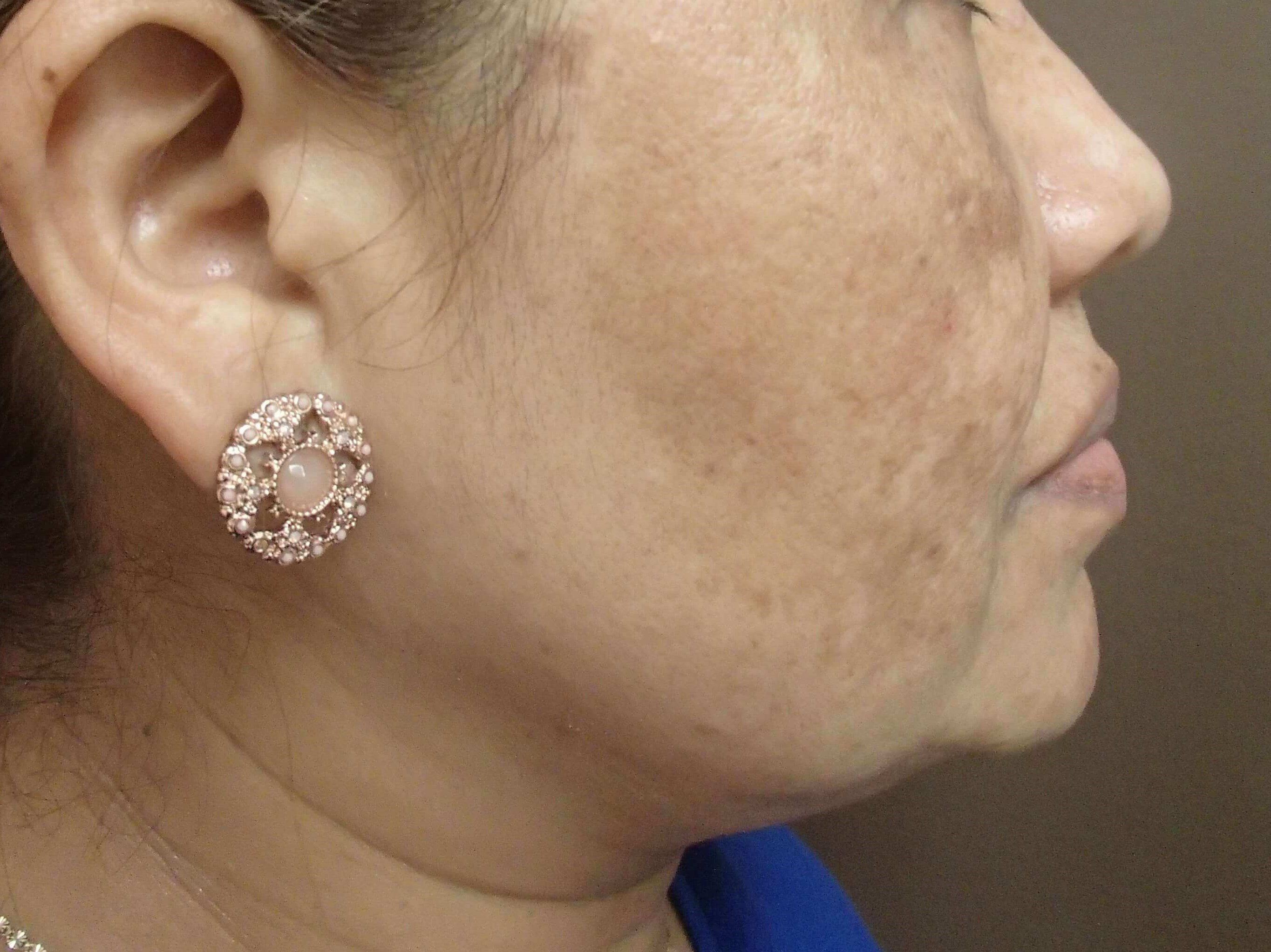 VI Precision Plus Peel After