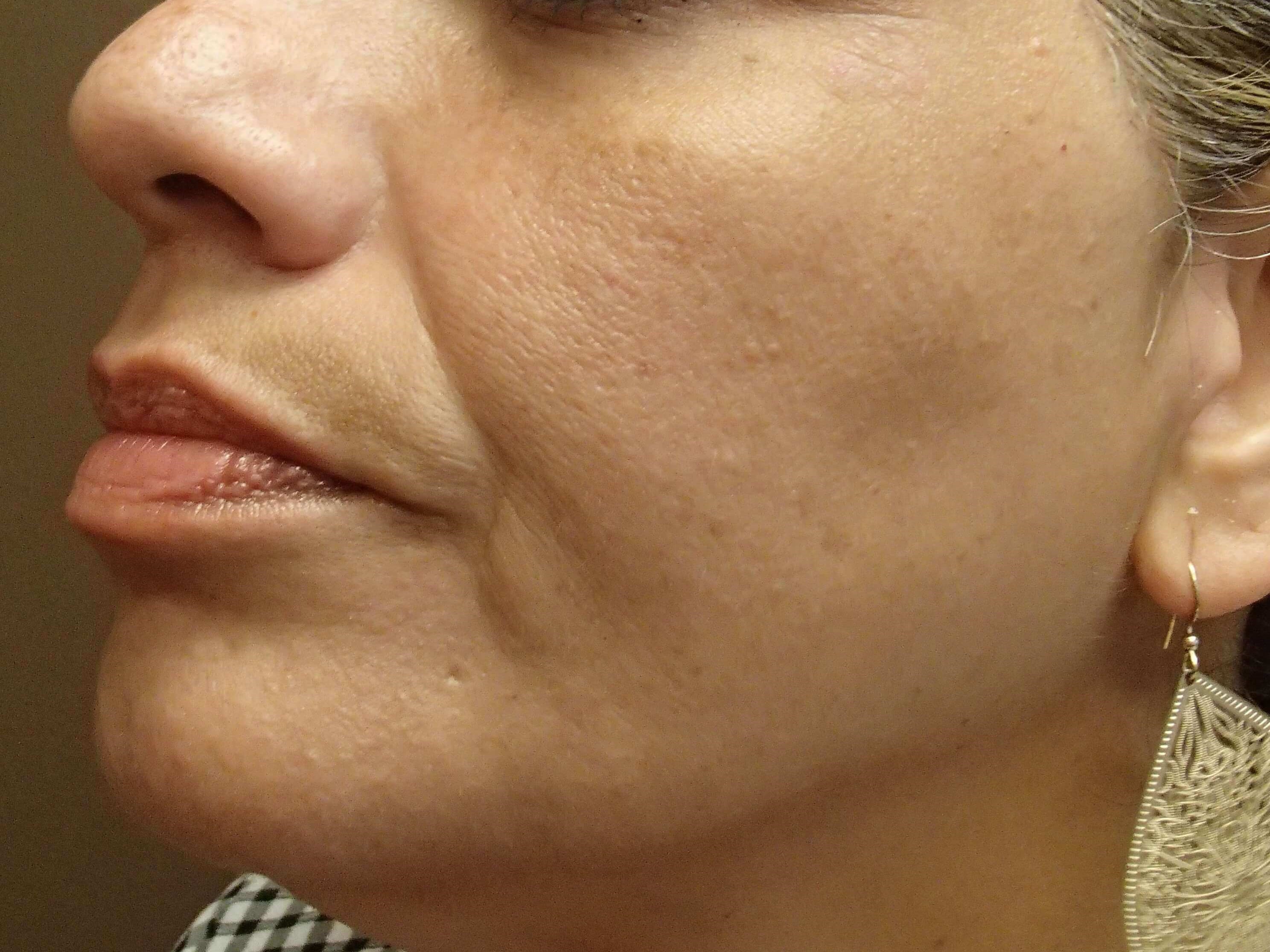 VI Precision Plus Peel Before