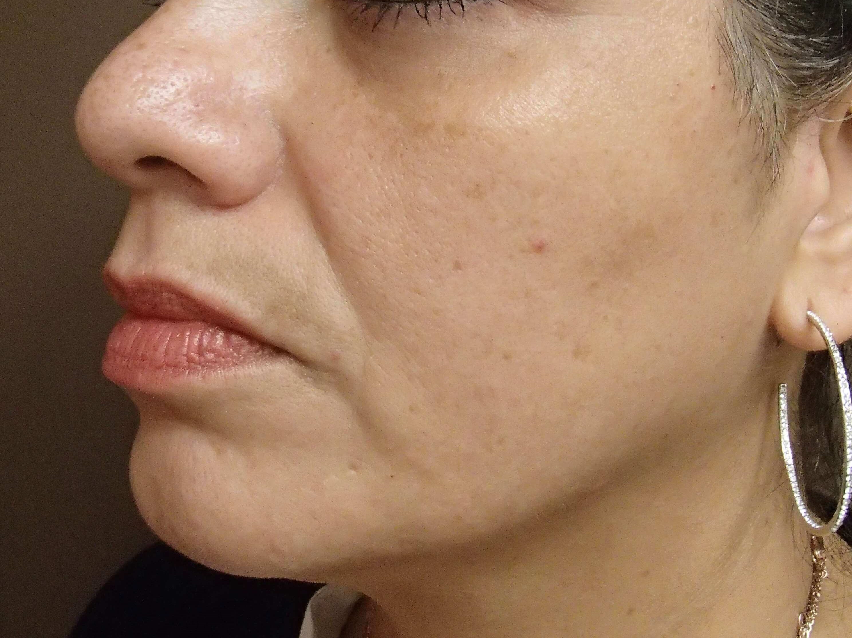 VI Precision Plus Peel After