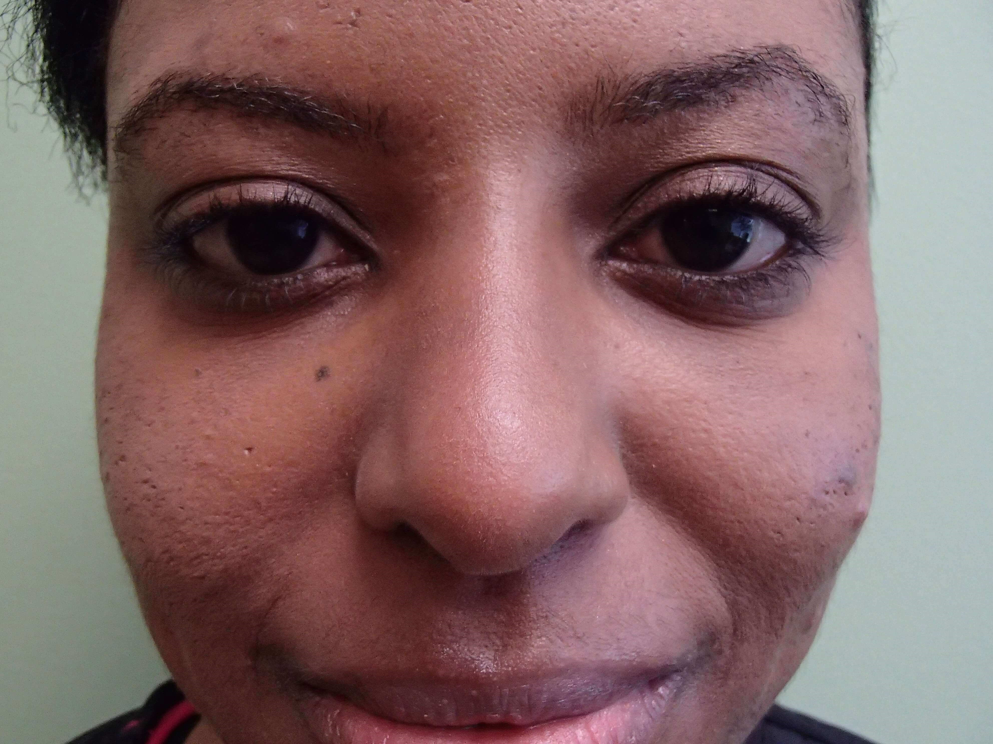 Rhinoplasty After