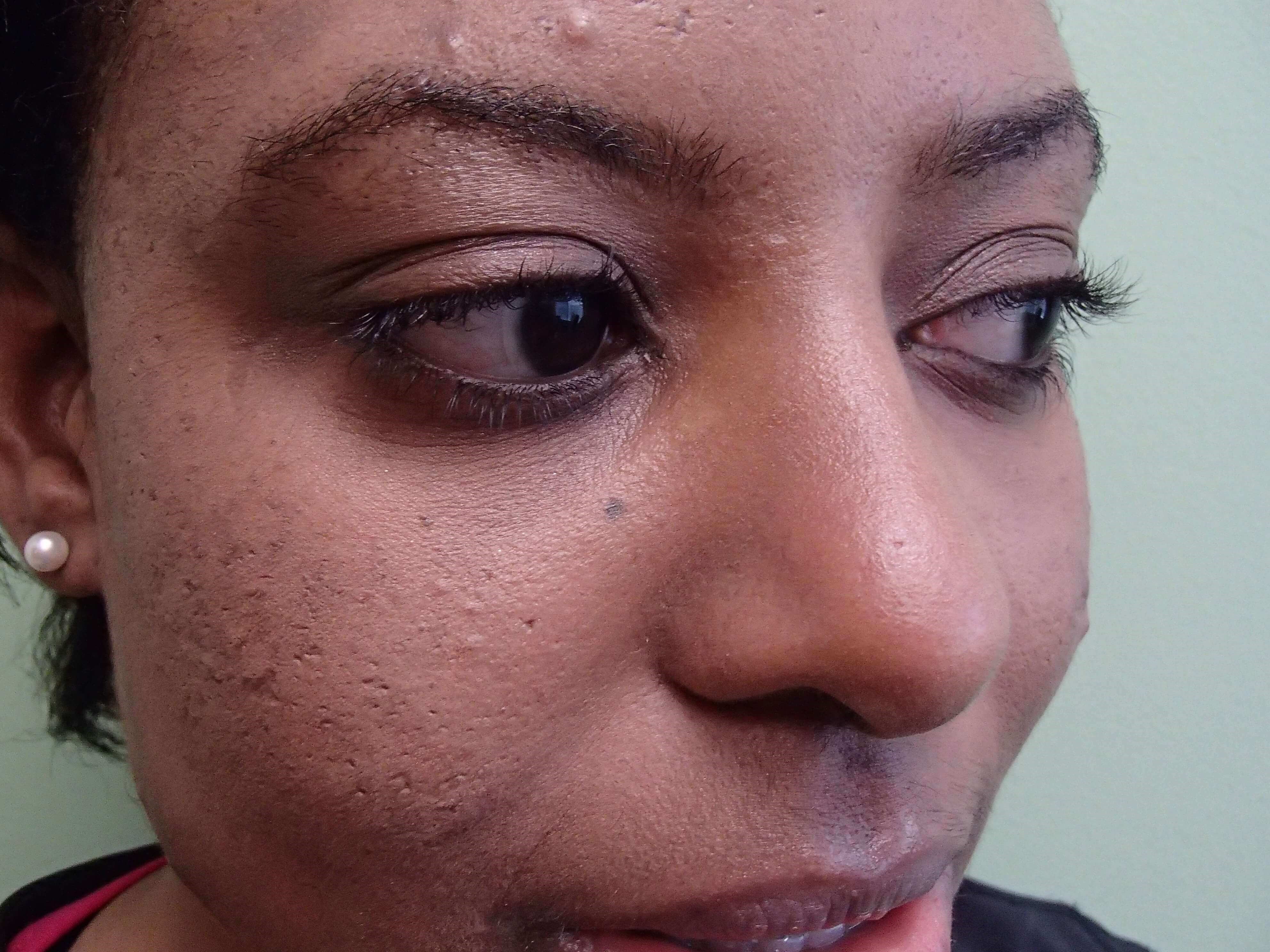 Rhinoplasty After