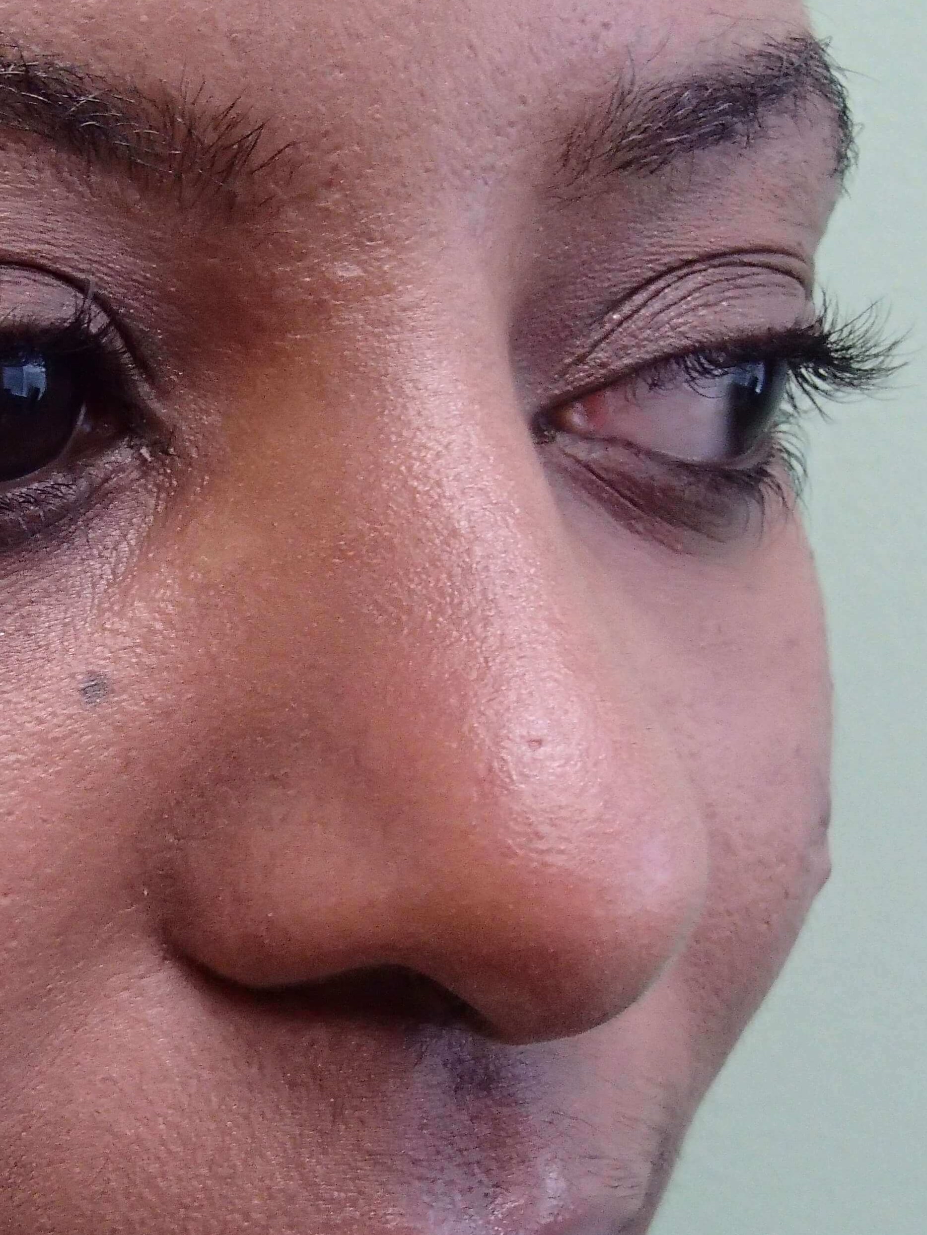 Rhinoplasty After