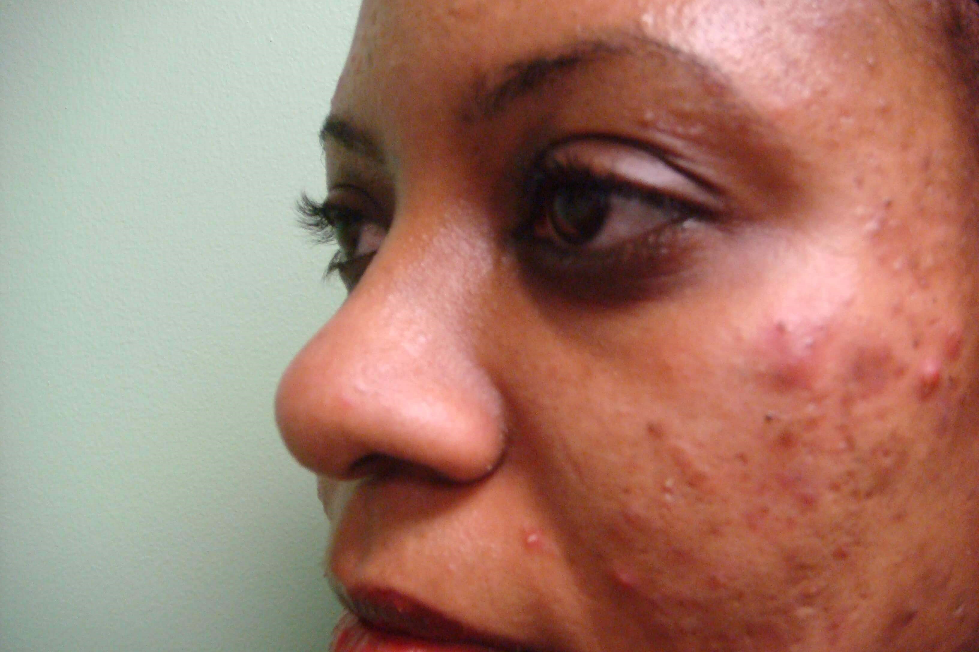 Rhinoplasty Before