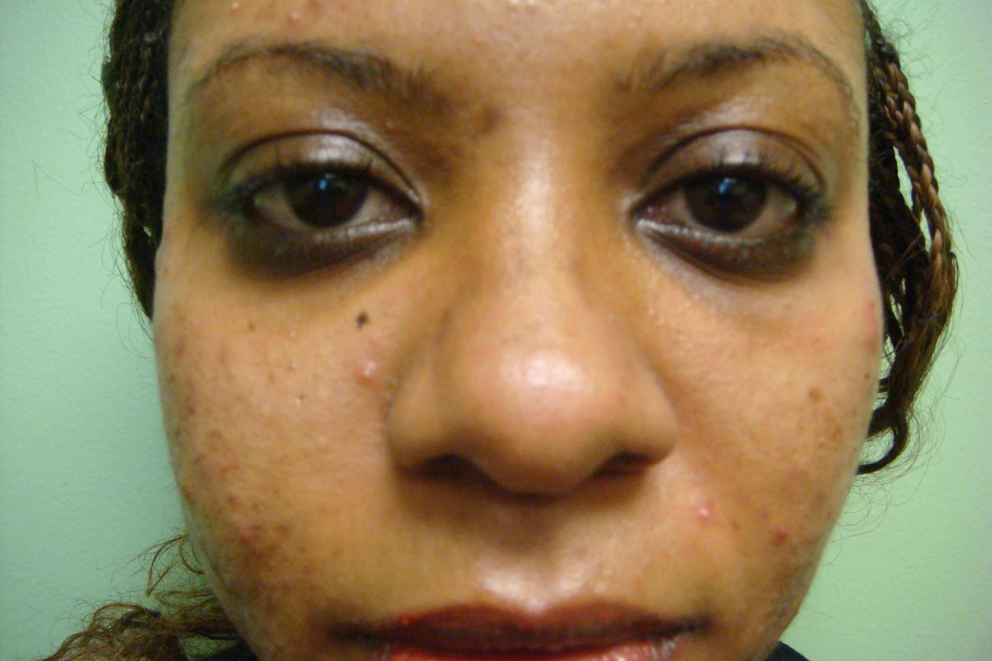 Rhinoplasty Before