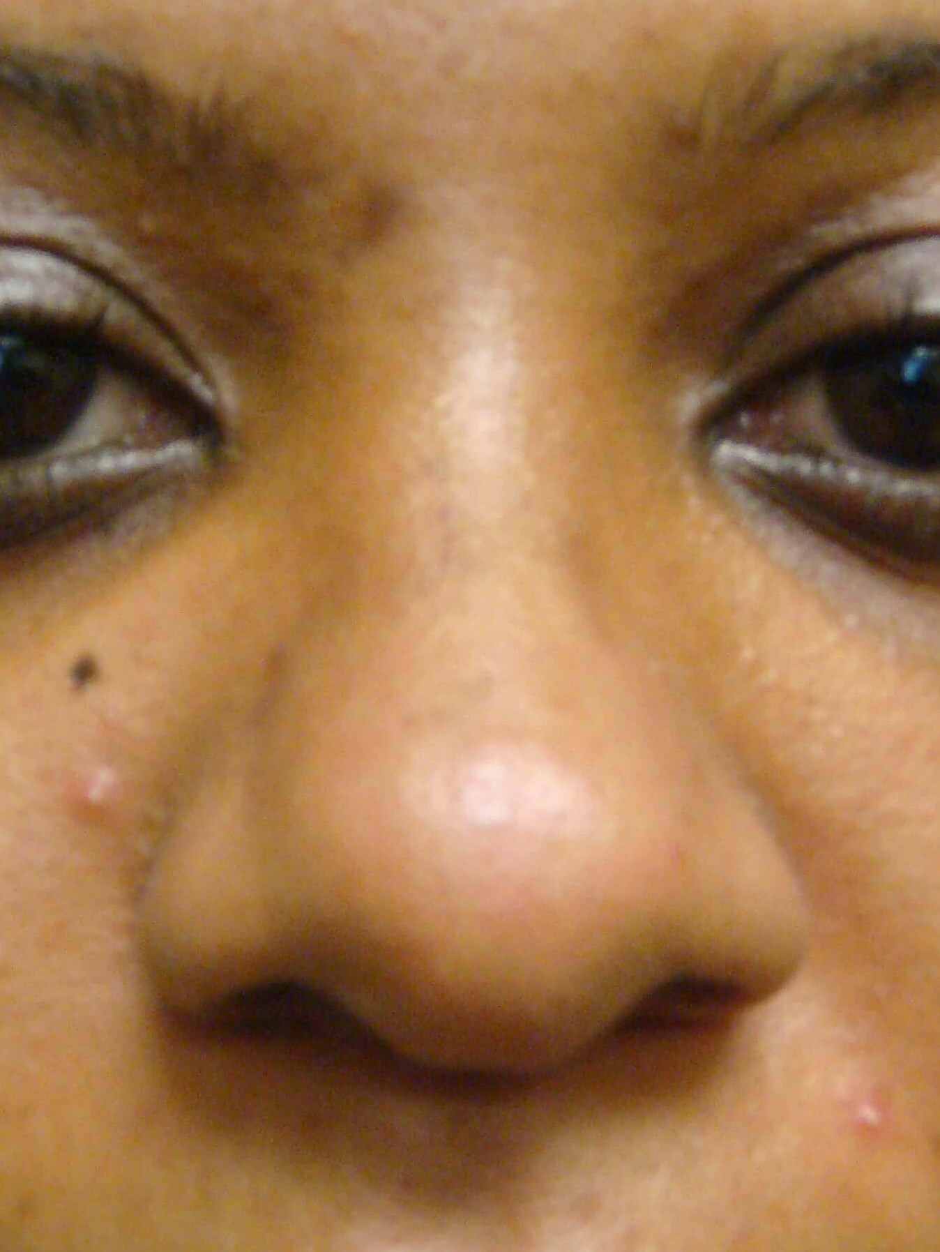 Rhinoplasty Before