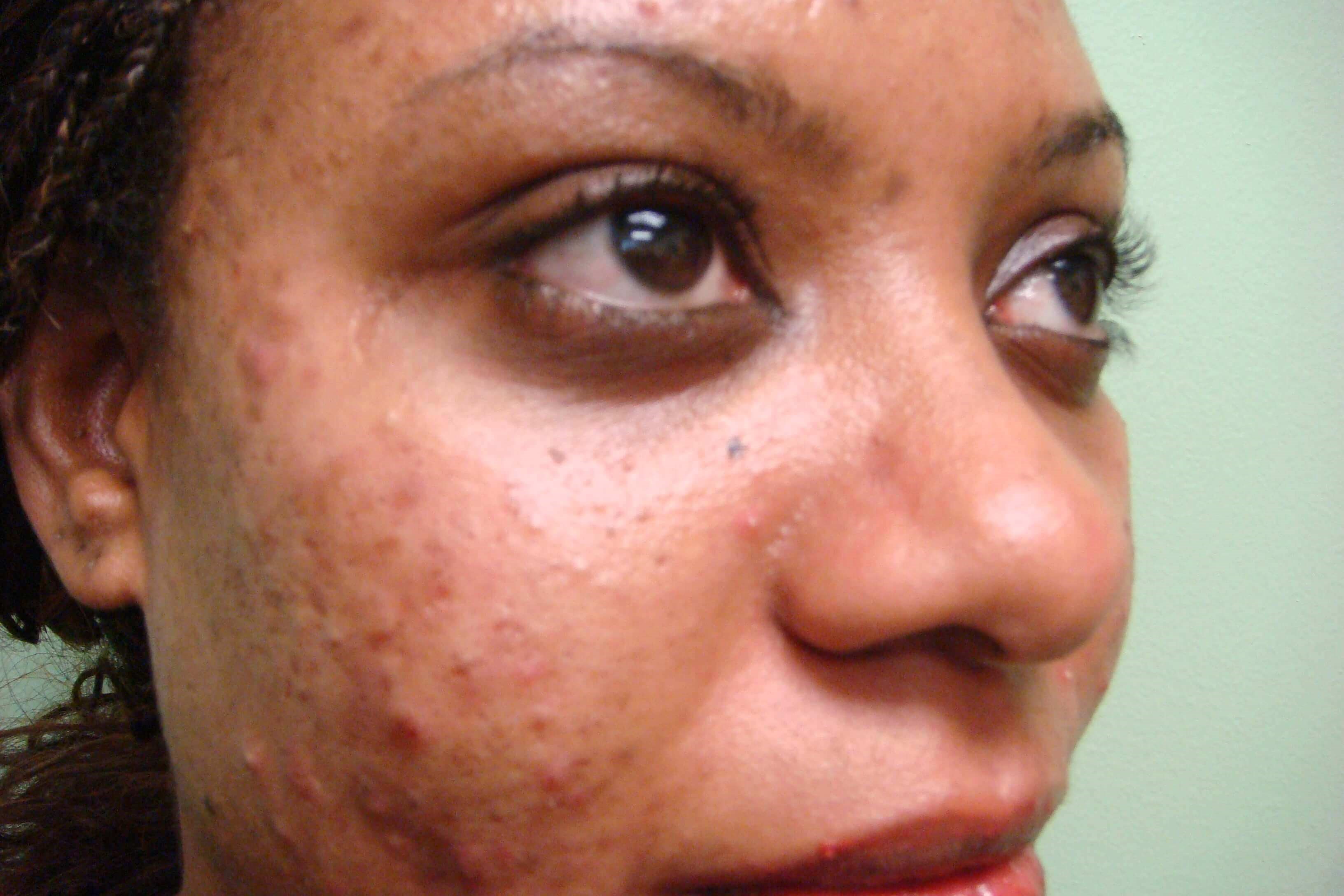Rhinoplasty Before