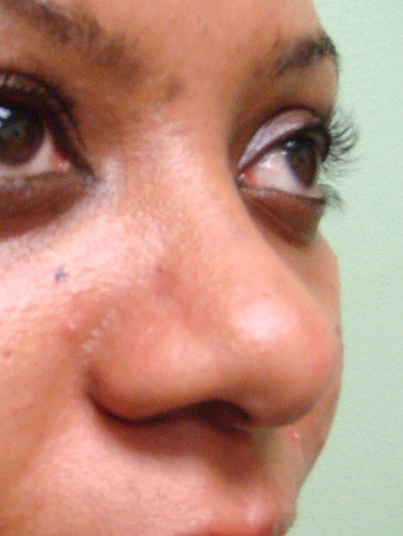 Rhinoplasty Before