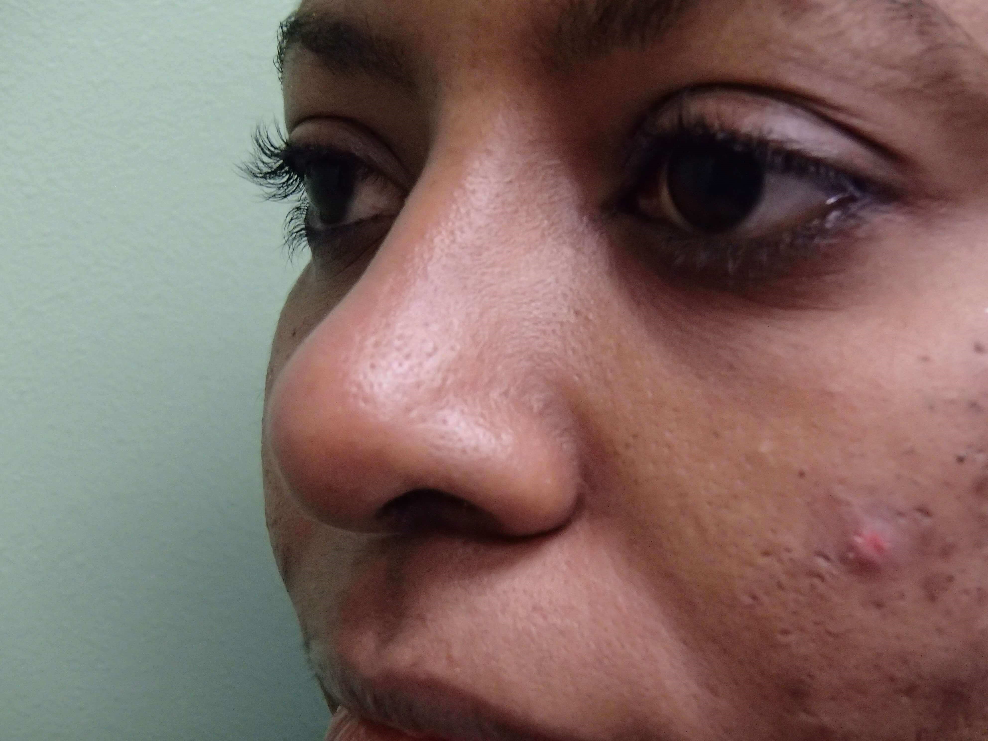 Rhinoplasty After
