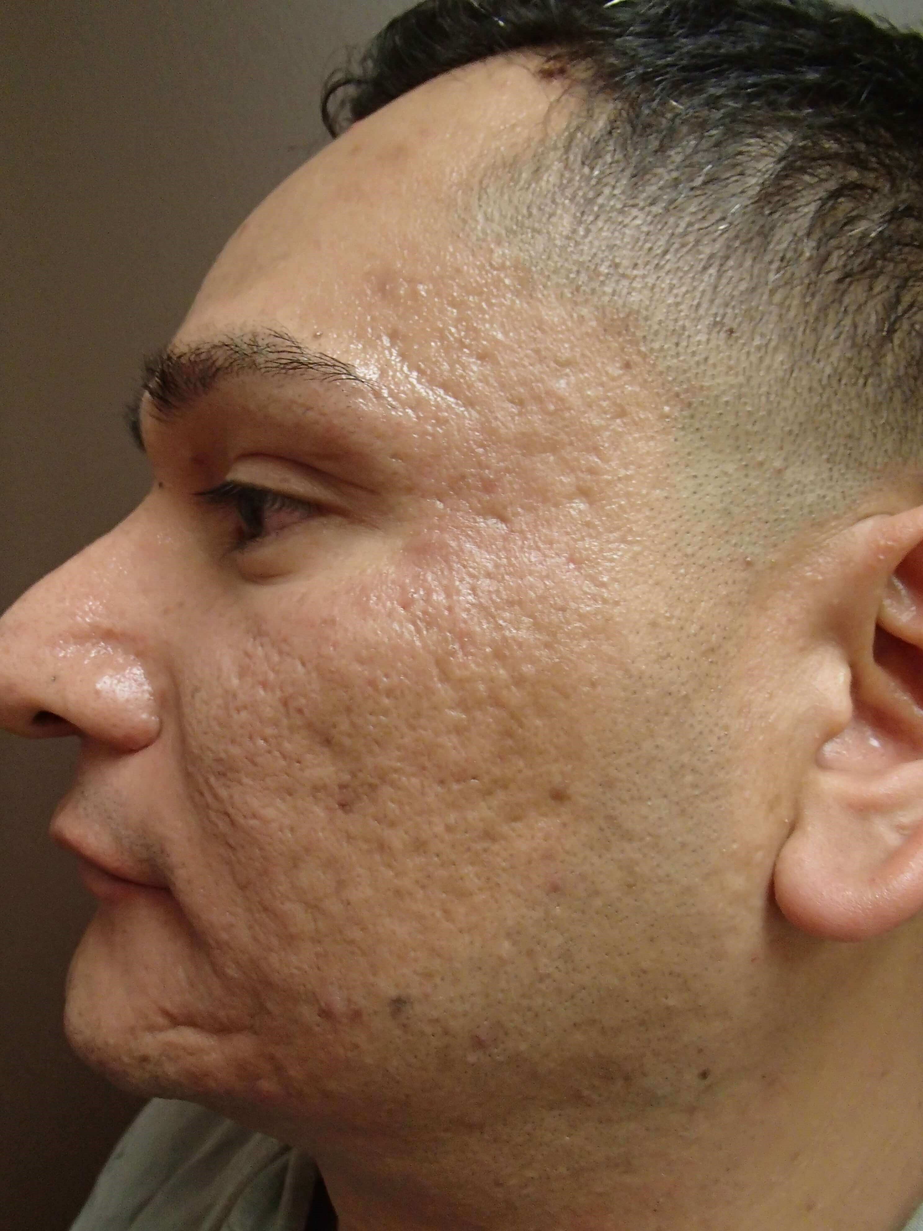 Erbium Laser Skin Resurfacing Before