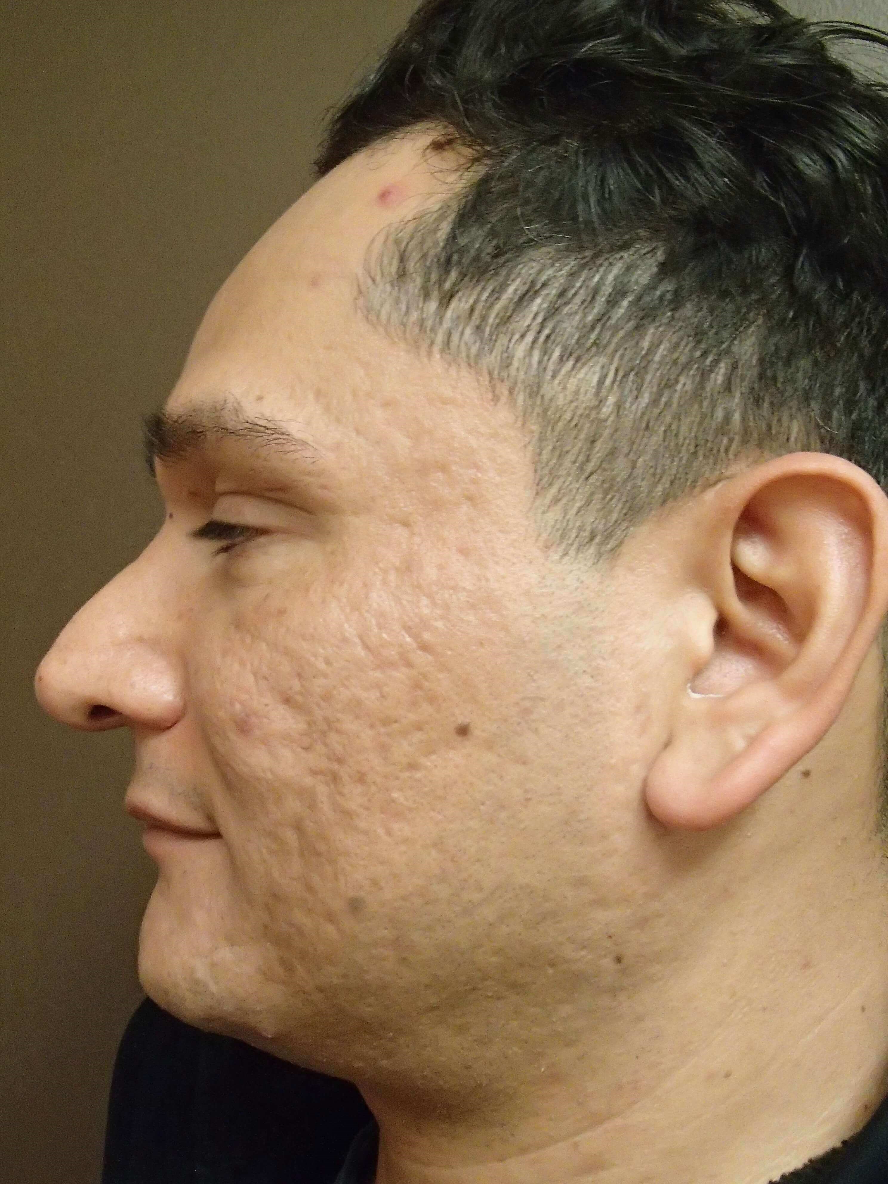 Erbium Laser Skin Resurfacing After