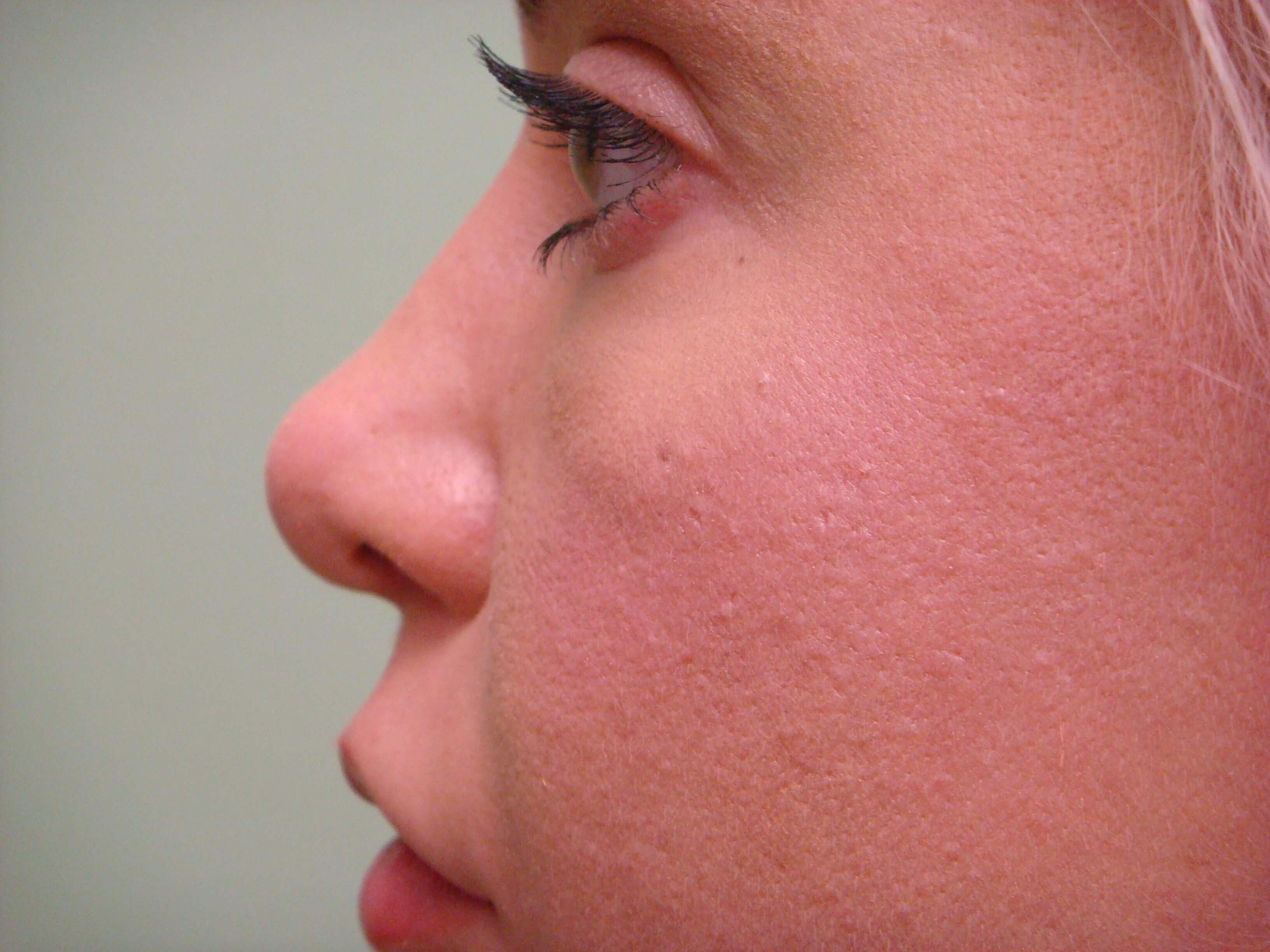 Rhinoplasty Before