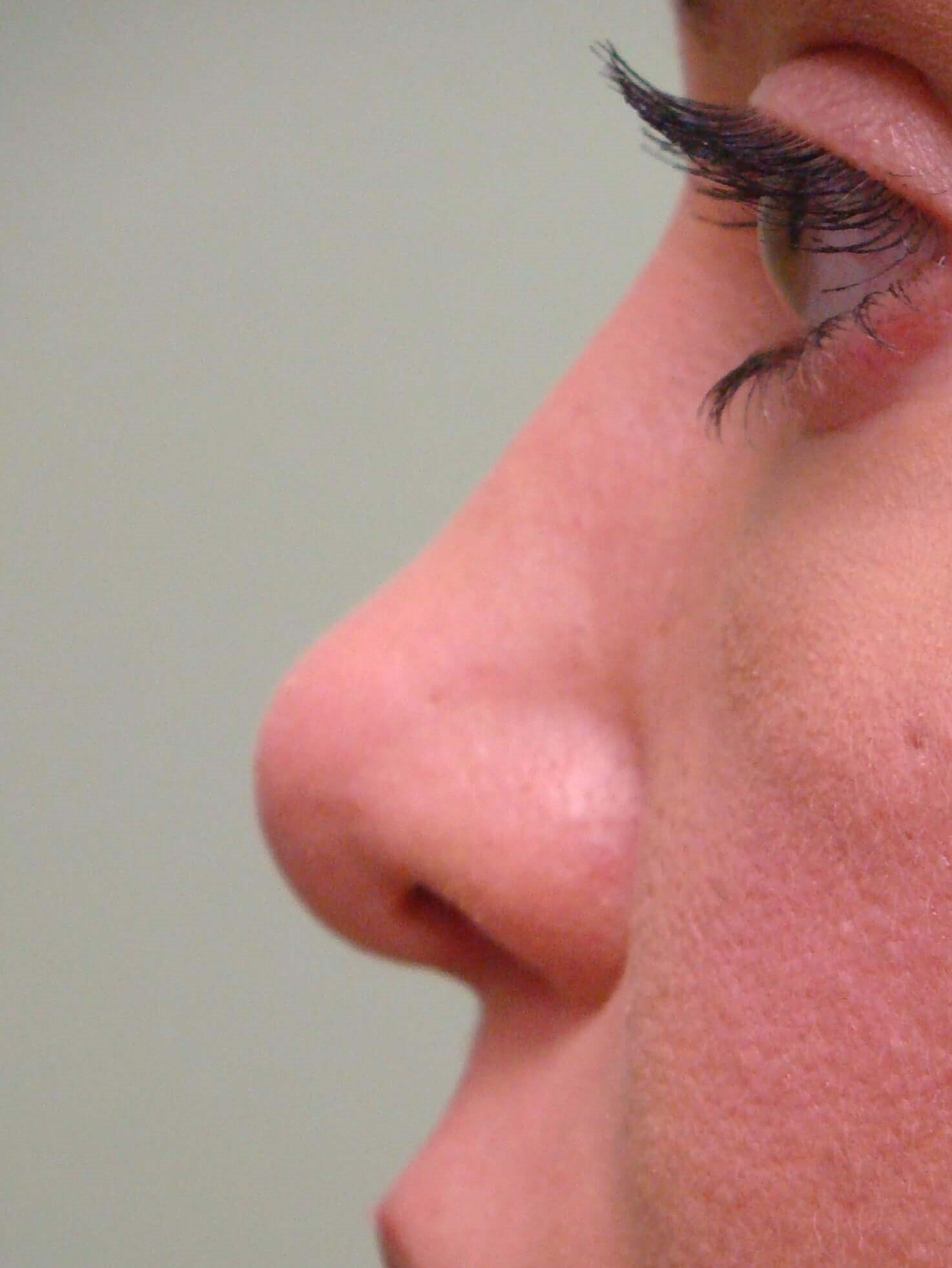 Rhinoplasty Before