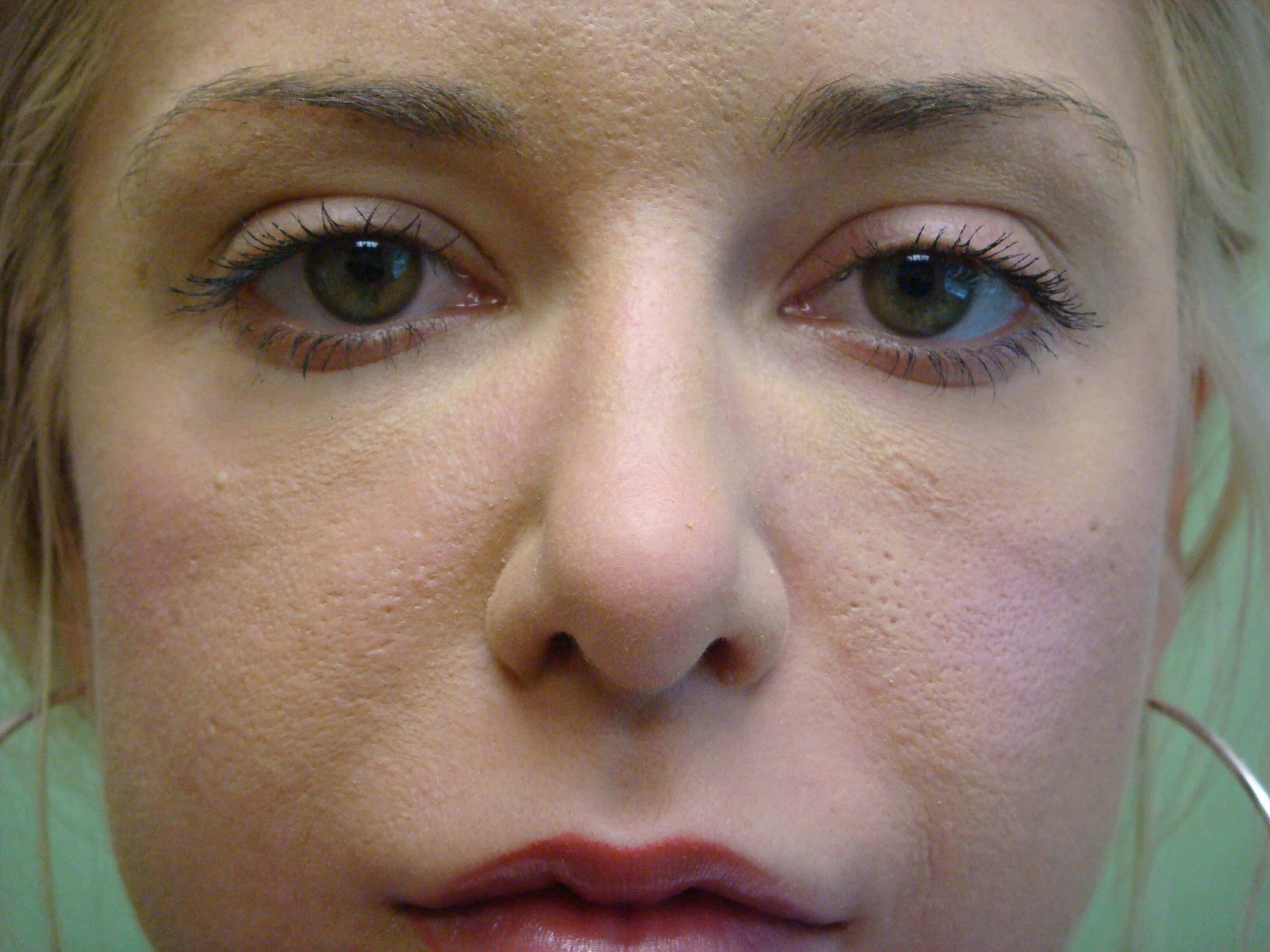Rhinoplasty After