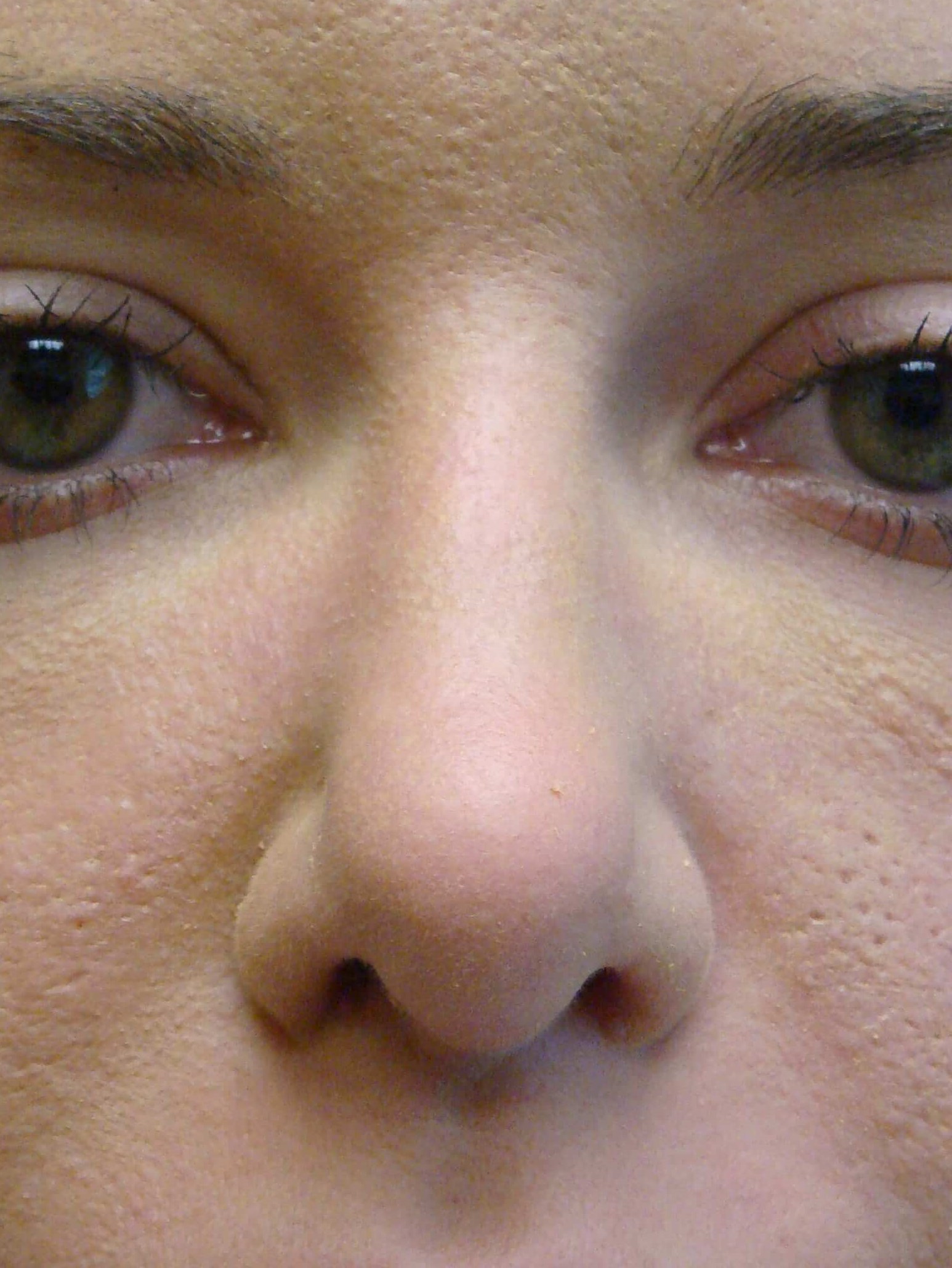 Rhinoplasty After