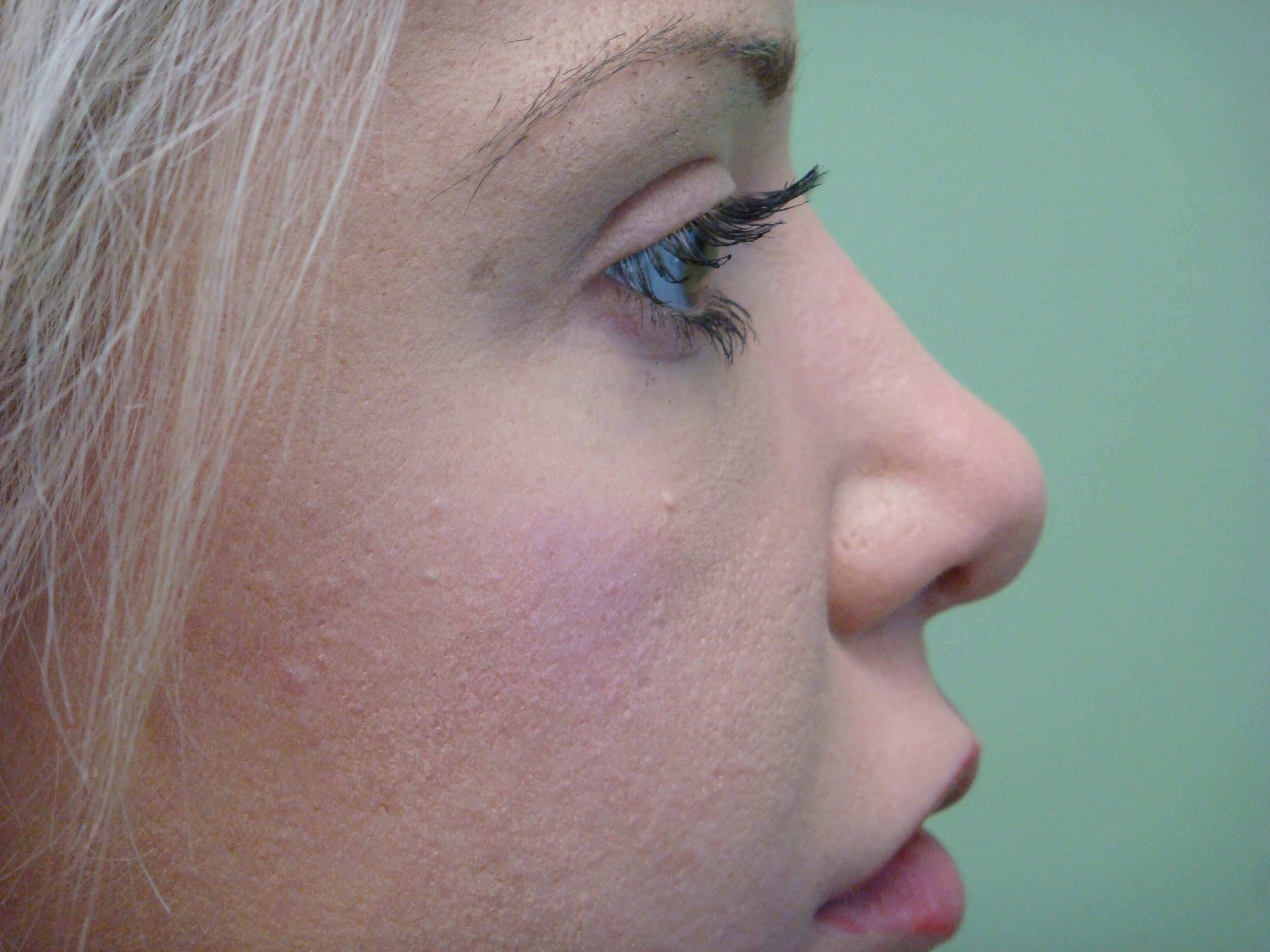 Rhinoplasty Before