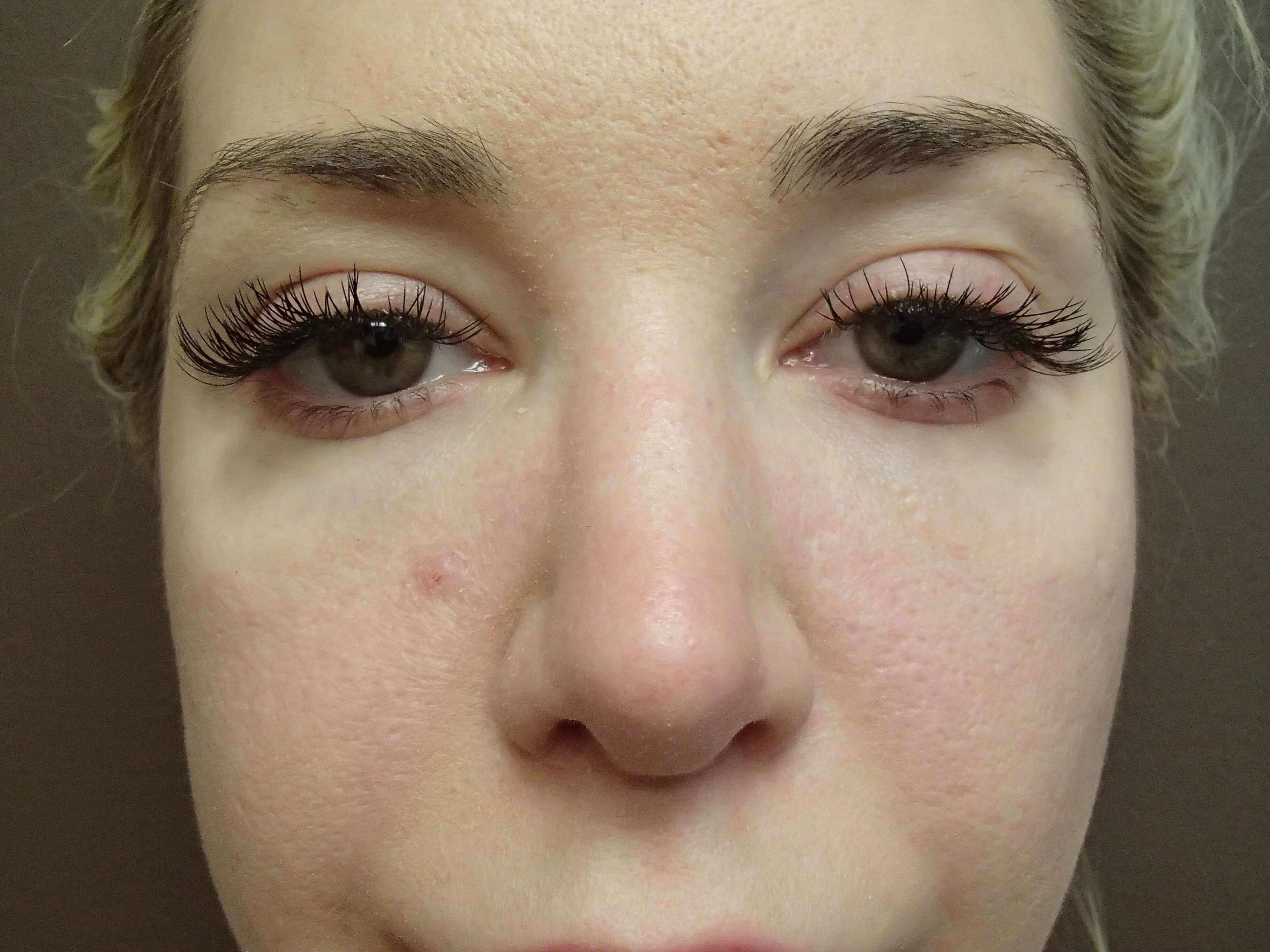 Rhinoplasty Before