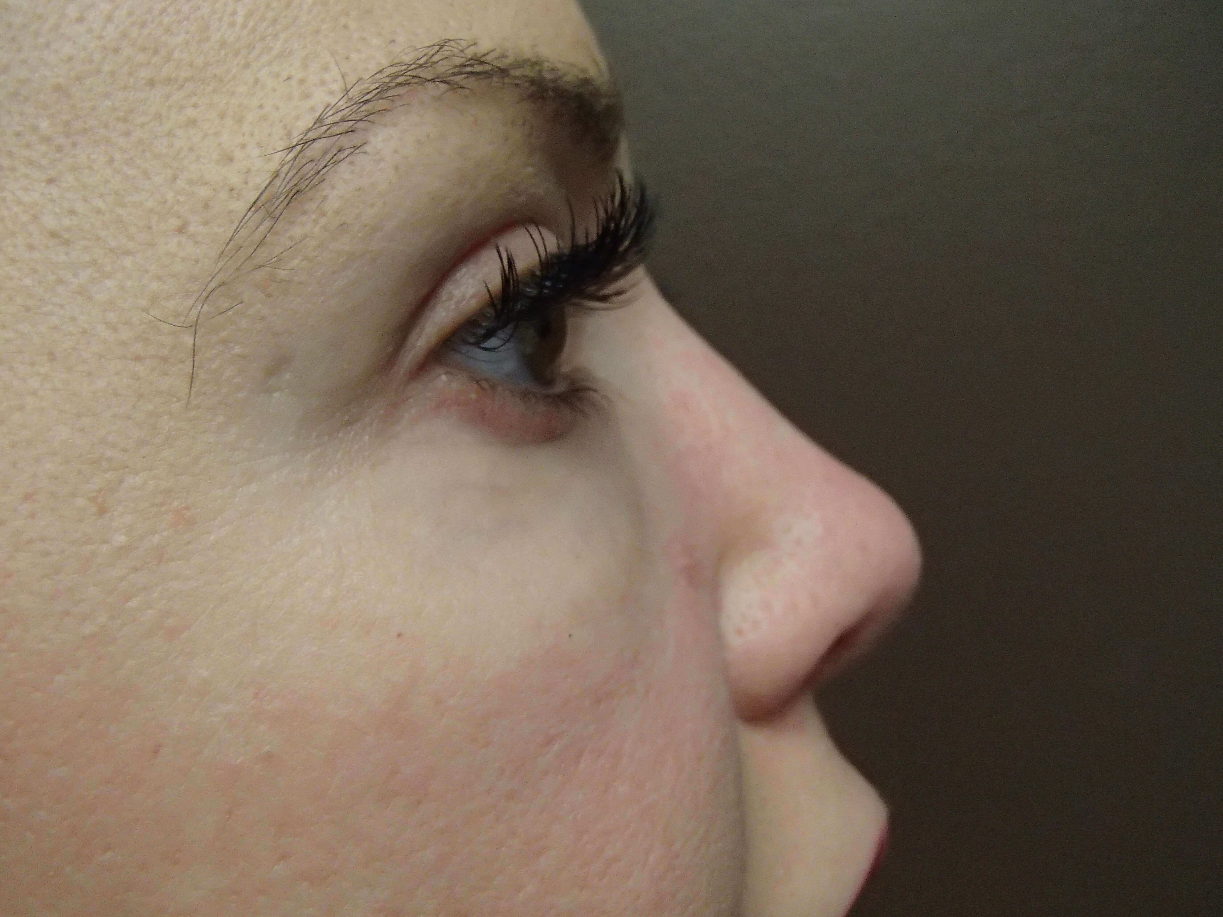 Rhinoplasty After