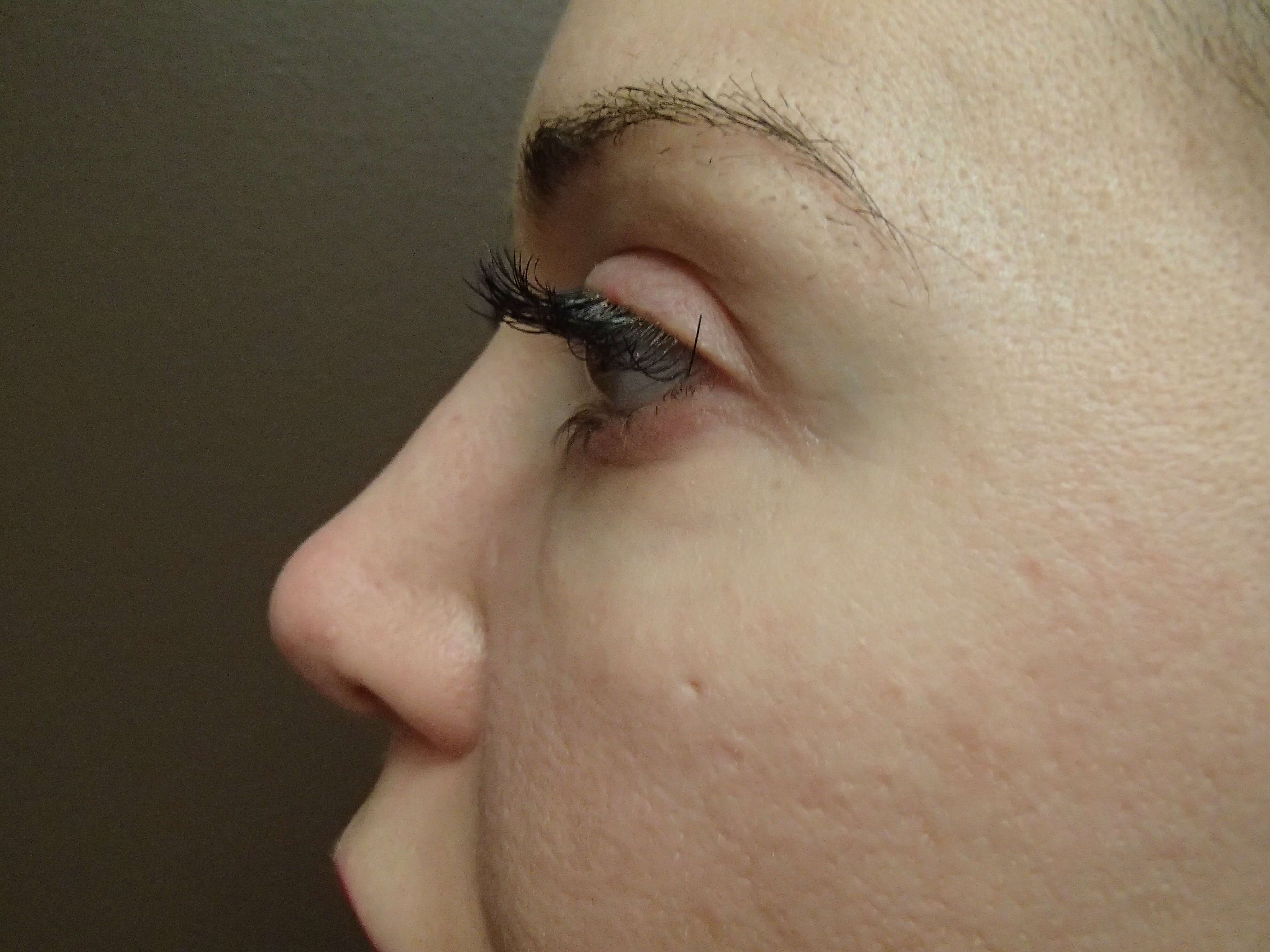 Rhinoplasty After